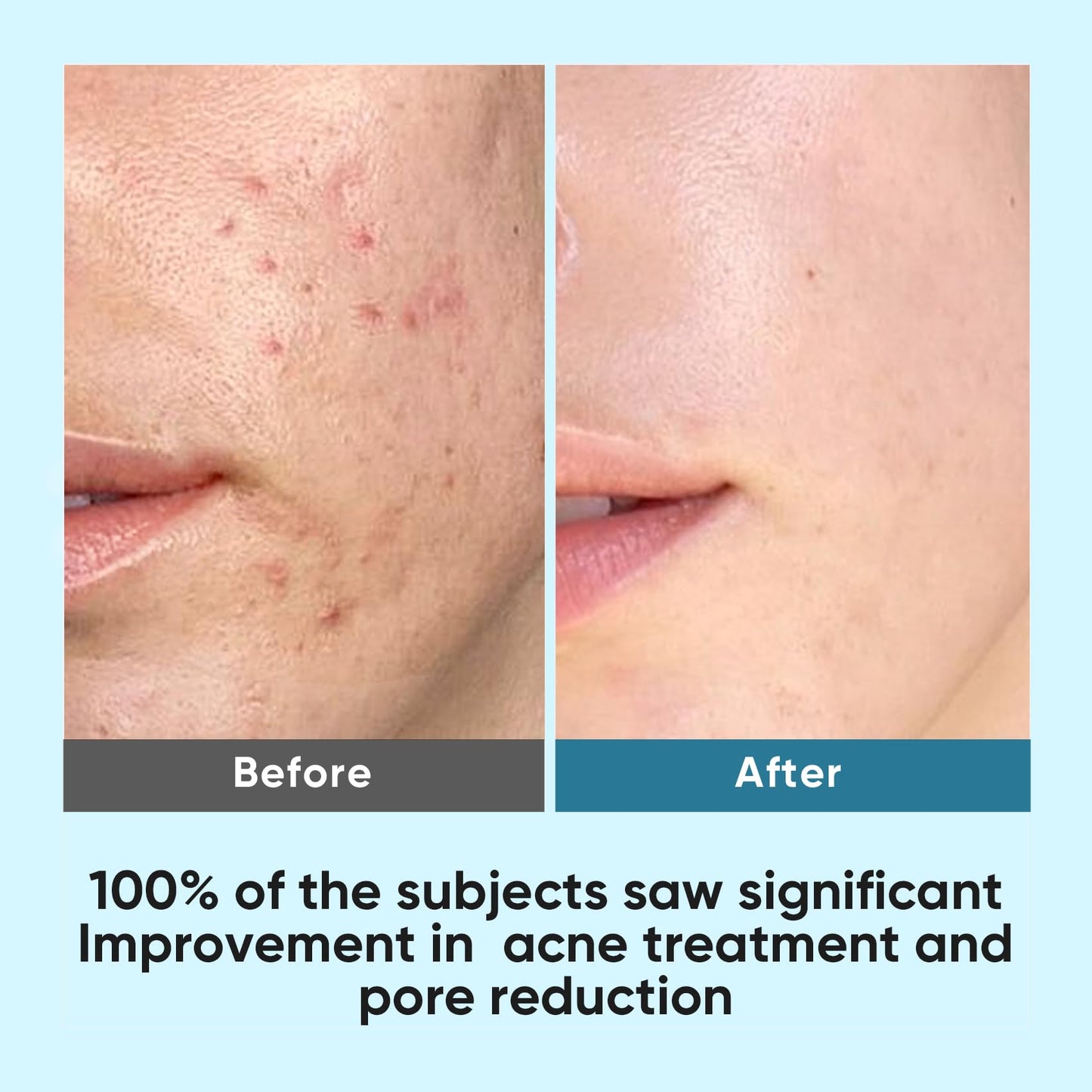 Elvira Glycolic Acid Exfoliating Facial Pads With 10% Glycolic Acid, 2% Salicylic Acid & Niacinamide - 60 Toner Pads, Daily Peel Treatment for Acne