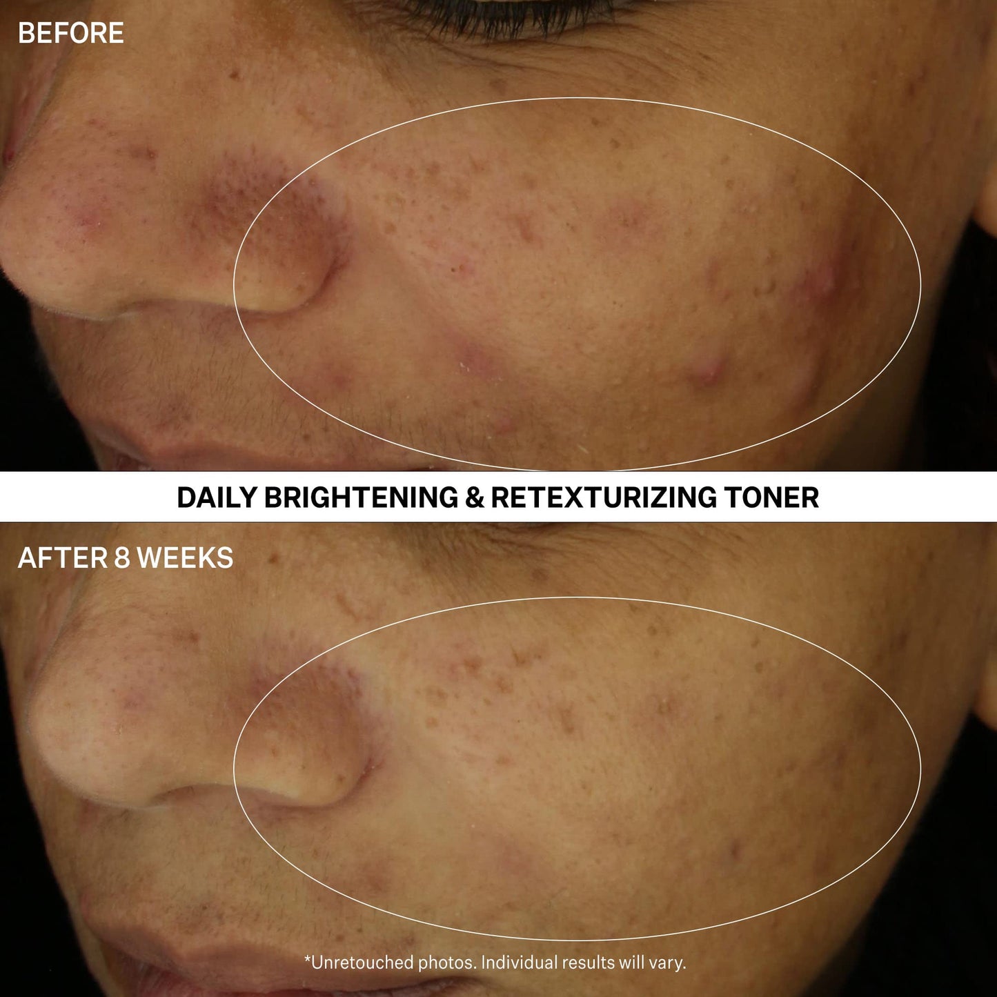 StriVectin Multi Action Clear Daily Brightening & Retexturing Toner for Acne and Blemish Prone Skin for Clearer, Smooth and Brighter Skin, Less