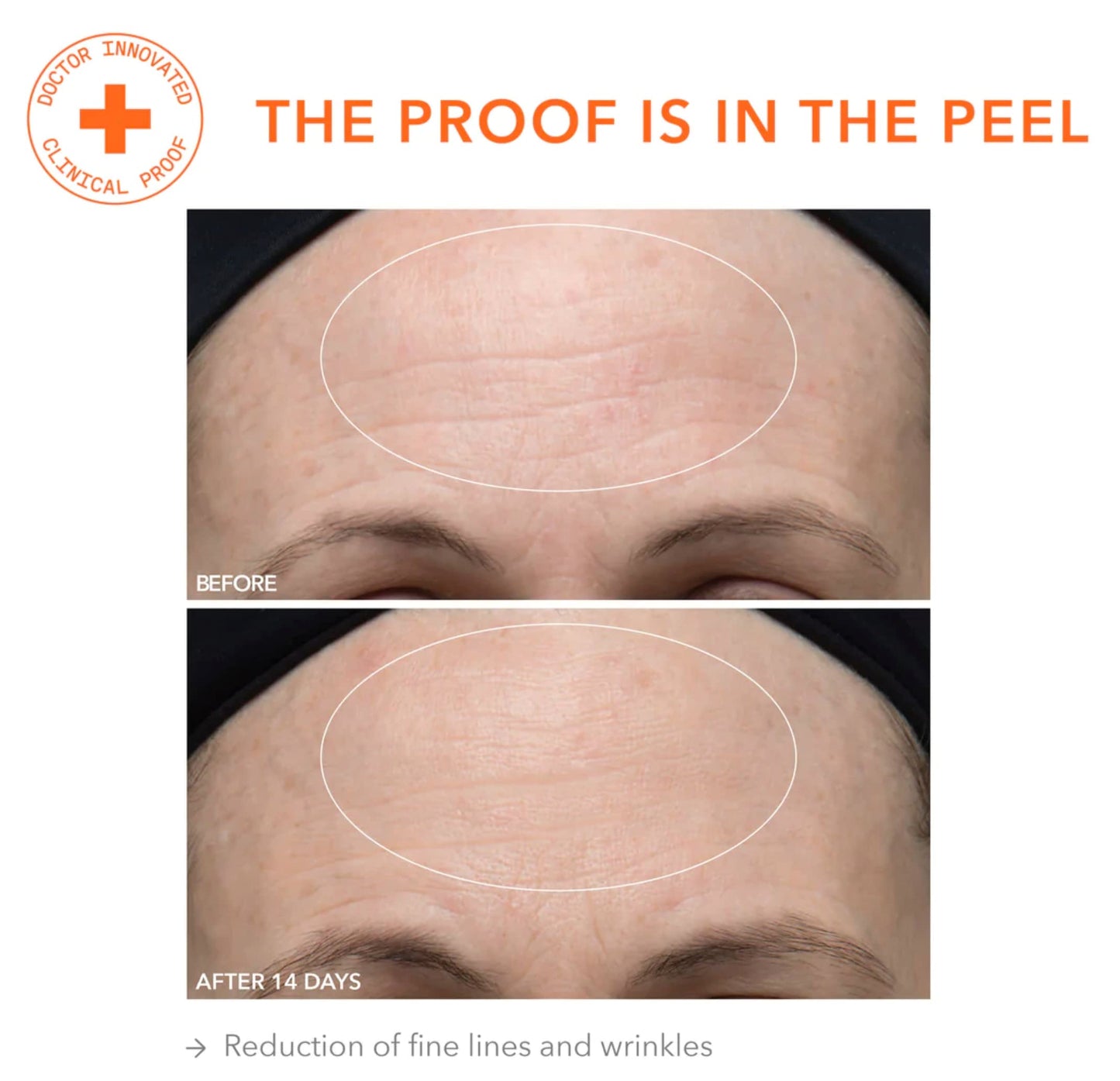 Dr. Dennis Gross Alpha Beta Ultra Gentle Daily Peel: for Dehydrated or Sensitive Skin, Uneven Tone or Texture, Fine Lines or Enlarged Pores (5