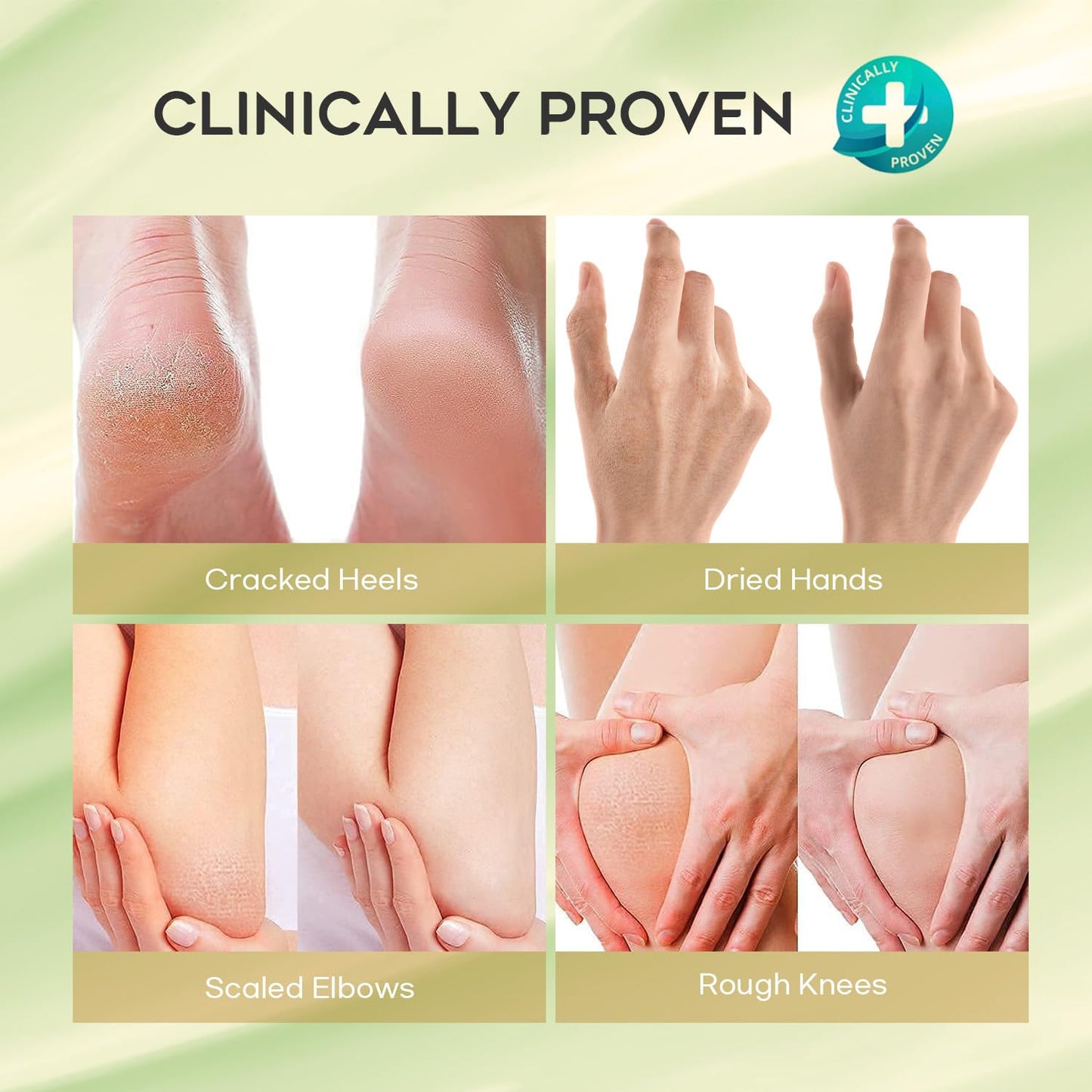 Vebuni Urea Cream 42% Foot Cream Salicylic Acid 4 Oz, Upgraded Callus Remover For Feet, Knees& Elbows, Intensive Moisturizes & Softens Skin
