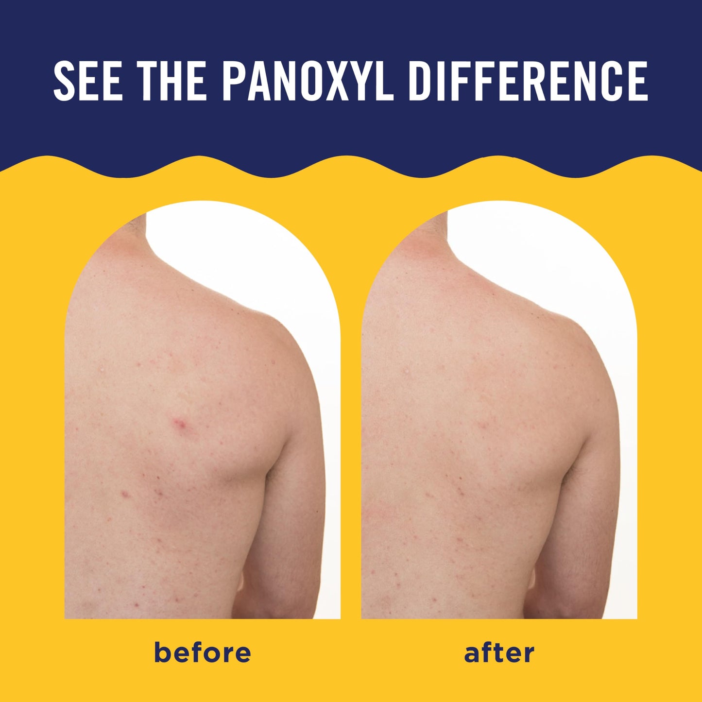PanOxyl Acne Banishing Body Spray with 2% Salicylic Acid, Pimple Treatment Spray to Clear Stubborn Breakouts, 360-Degree Spray Nozzle Beauty and Personal Care PanOxyl