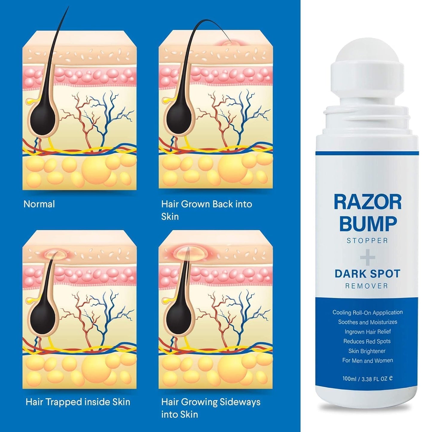 Razor Bump Stopper with Ingrown Hair Treatment: Razor Bumps Treatment for Men and Women, After Shave Solution for Ingrown Hairs and Razor Burns, Roll Beauty and Personal Care Sielkin
