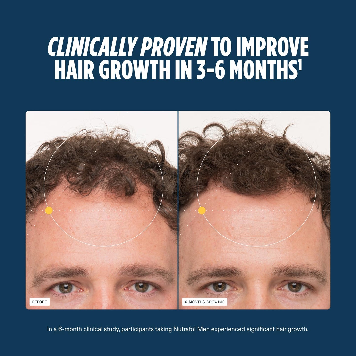 Nutrafol Men's Hair Growth Supplements, Clinically Tested for Visibly Thicker Hair and Scalp Coverage, Dermatologist Recommended - 1 Month Supply, 1 Beauty and Personal Care Nutrafol
