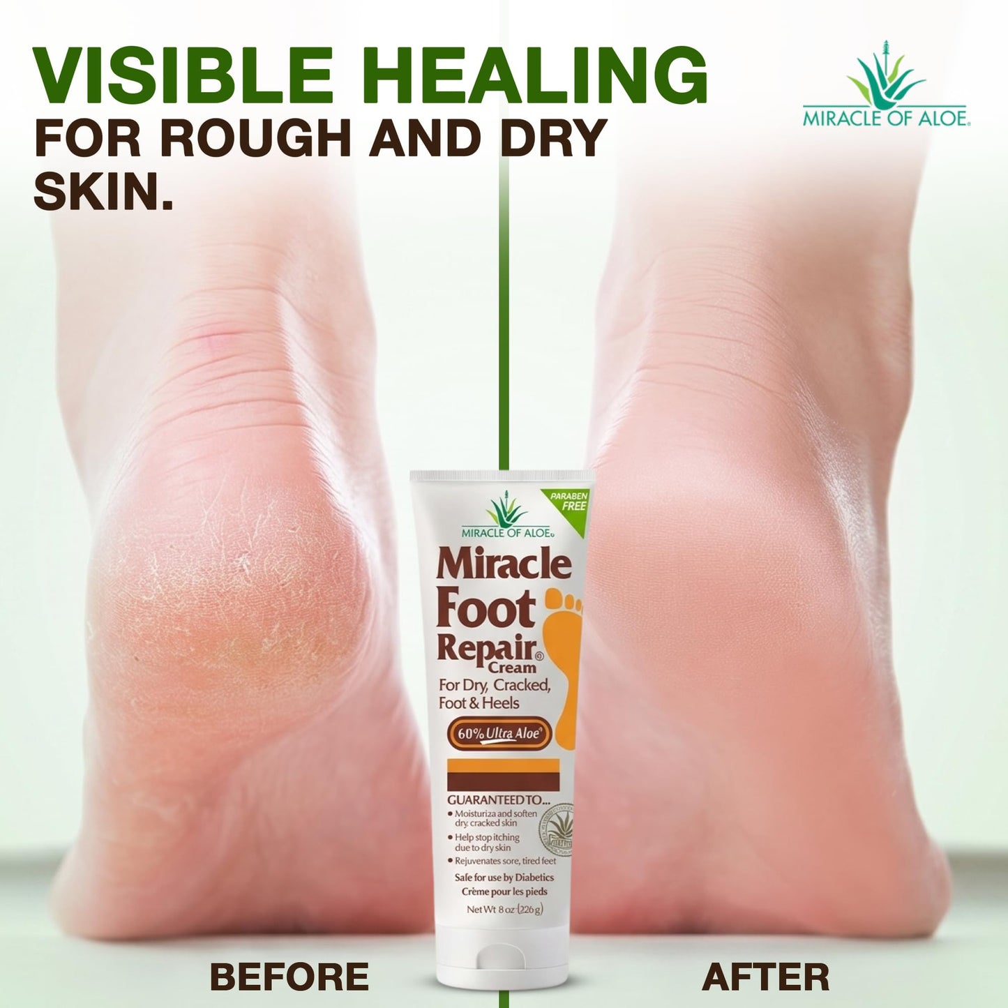Miracle Foot Repair Cream (8 oz) Repairs Dry Cracked Heels and Feet, 60% Pure UltraAloe Moisturizes, Softens, and Repairs Beauty and Personal Care Miracle of Aloe