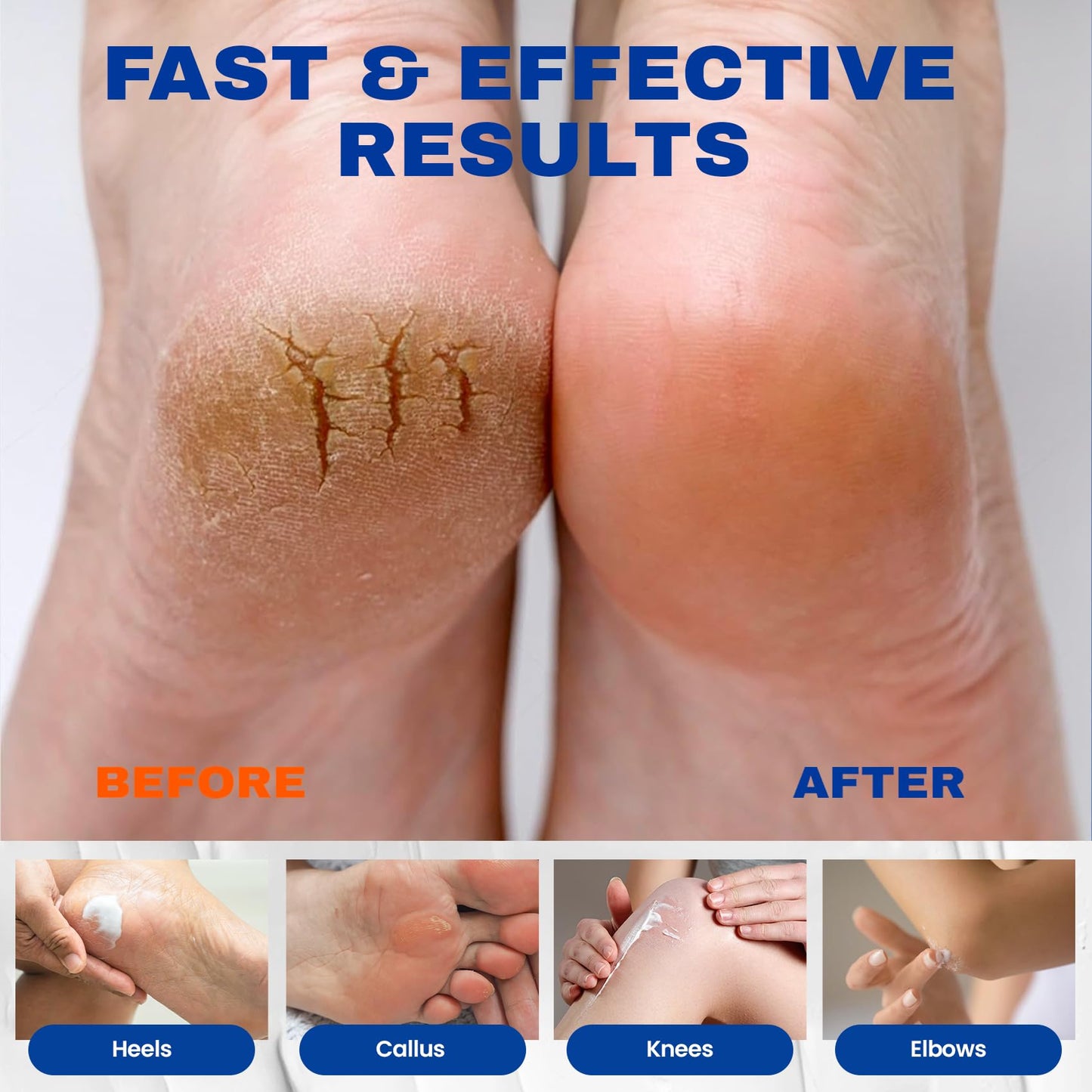 SKIN ULTIMA Urea Cream 40 Percent Plus 2% Salicylic Acid, 40% Urea Cream for Feet Maximum Strength, Foot Cream for Dry Cracked Feet, Heels, Knees Beauty and Personal Care SKIN ULTIMA