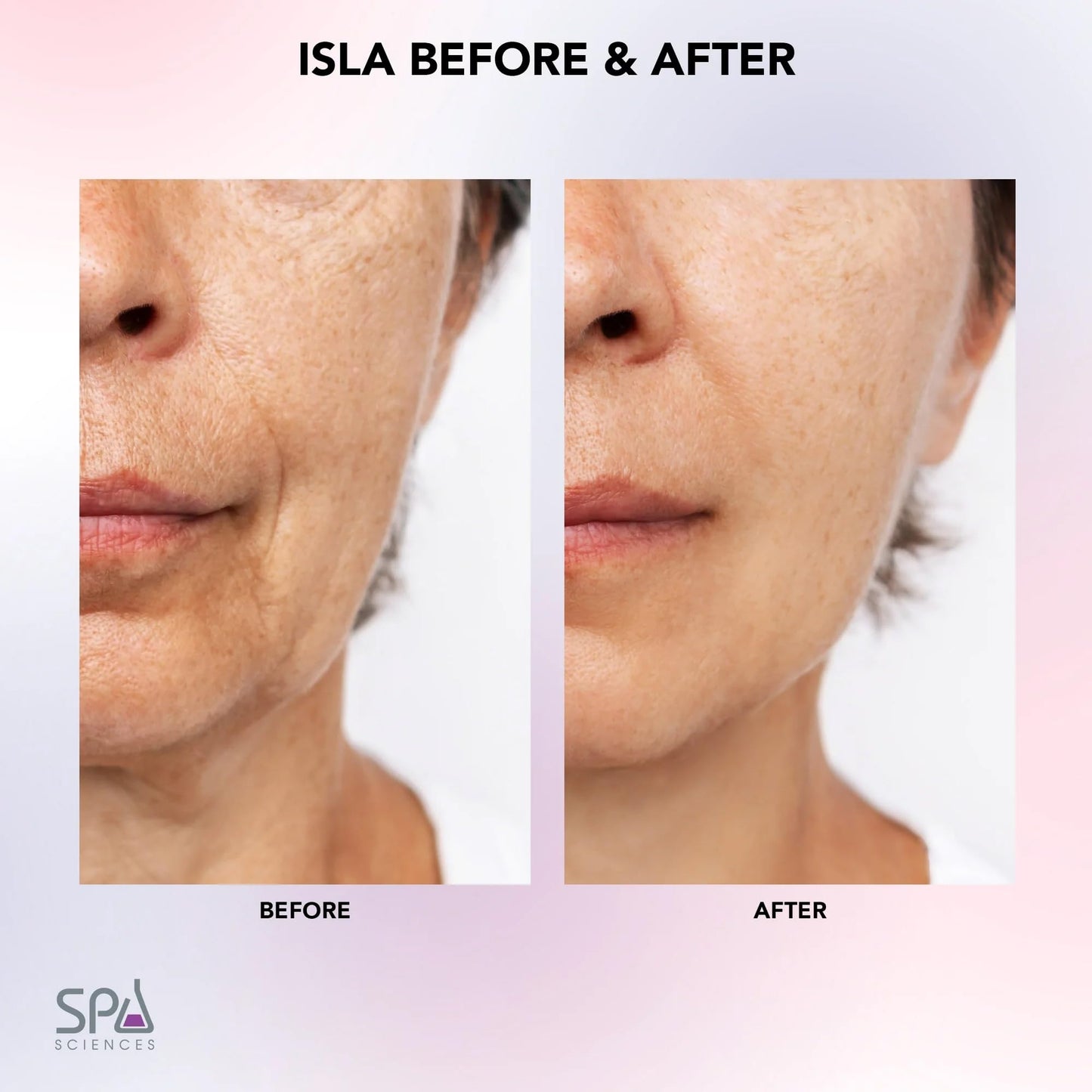 Spa Sciences ISLA Ice + Heat Contouring Roller (Face, Neck, and Décolletage) - Including Steel + Bonus Genuine Rose Quartz Globes