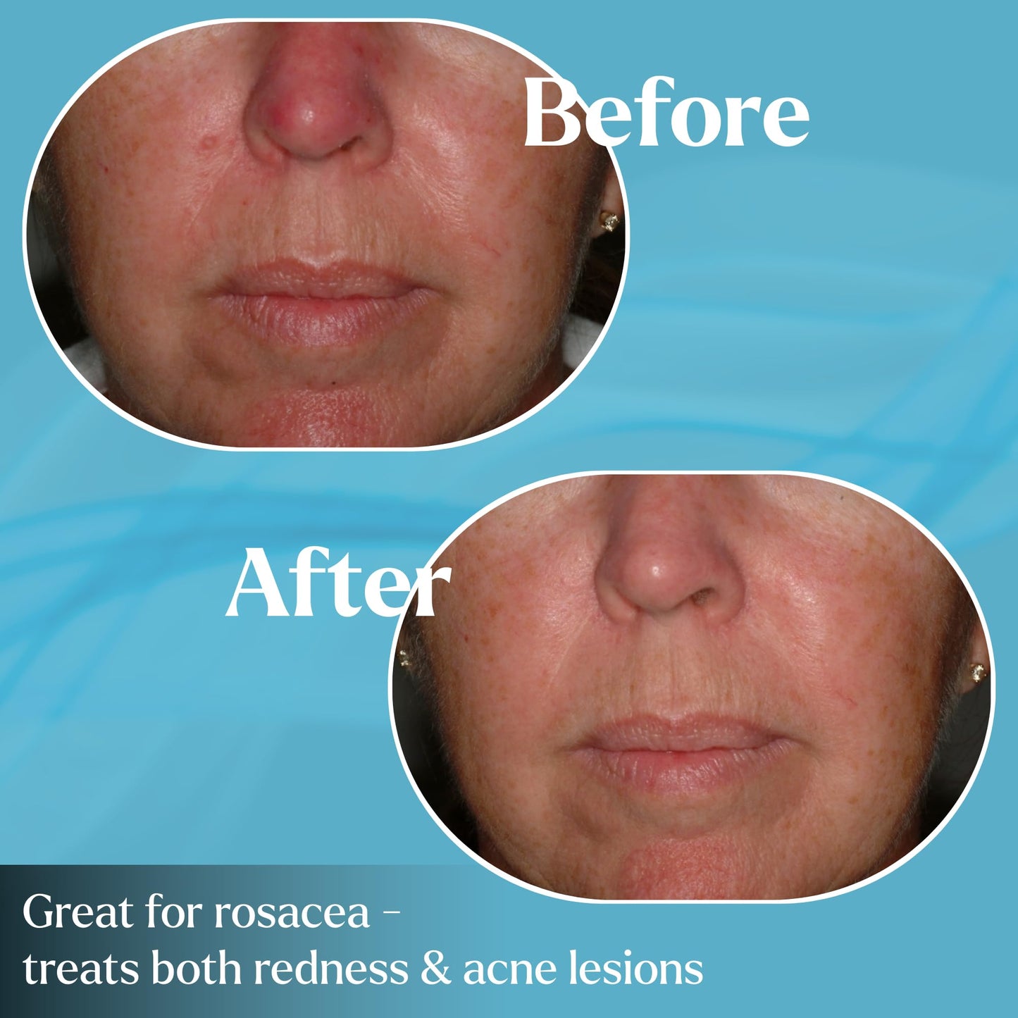 Advanced Pyratine A1 Soft Crème - Cytokinin Antiaging & Rosacea Treatment - Skin Cream Reduces Facial Redness, Acne Lesions, Spider Veins, Fine Lines