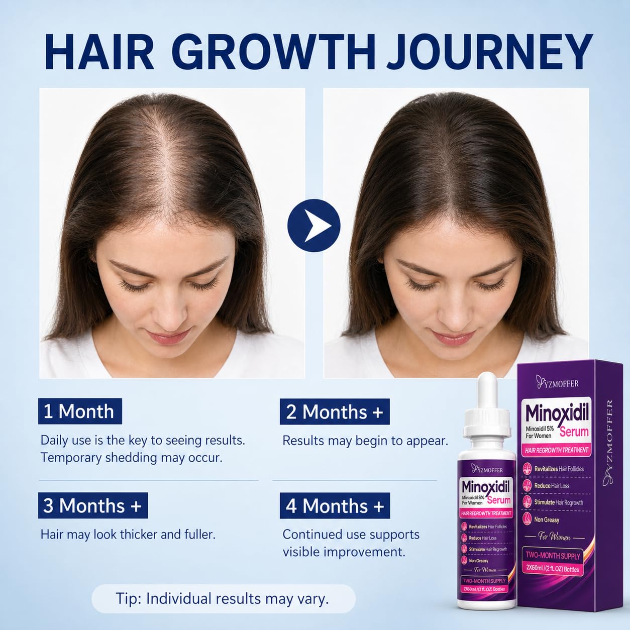 Minoxidil 5% Hair Regrowth Treatment for Women, Topical Serum Drops for Thinning Hair, Revitalizes Hair Follicles, Reduces Hair Loss, Non-Greasy Beauty and Personal Care Yzmoffer