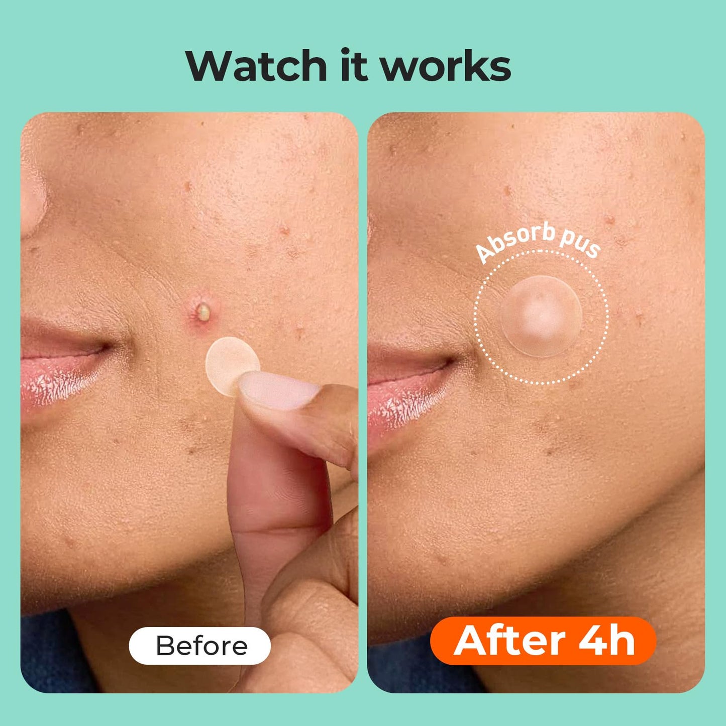 TKTK Pimple Patches for Face, 6 Sizes Hydrocolloid Acne Patch Variety, Large Acne Stickers for Cheeks, Forehead, Chin, Nose, Back Blemishes Zit Beauty and Personal Care TKTK