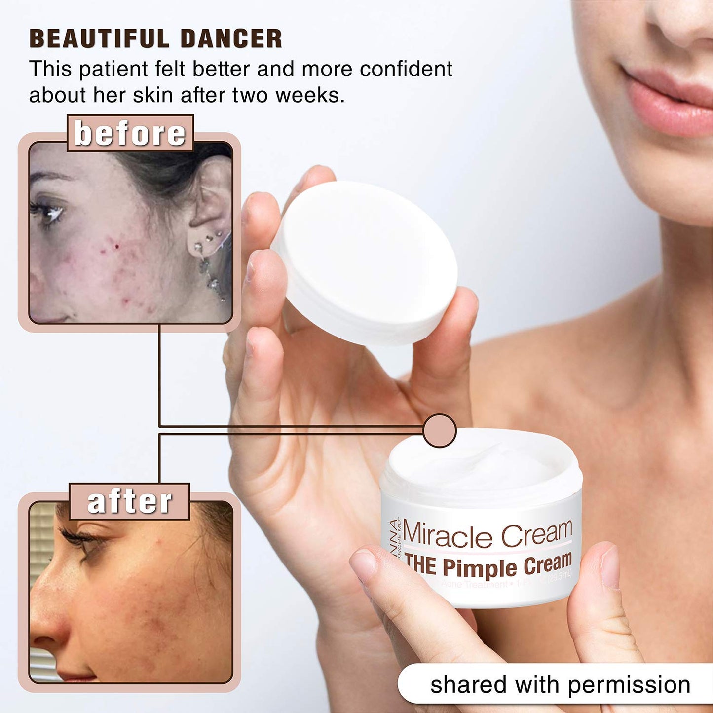 Anna Guanche MD Miracle Cream - Acne Treatment that Quickly Reduces Pimples & Redness