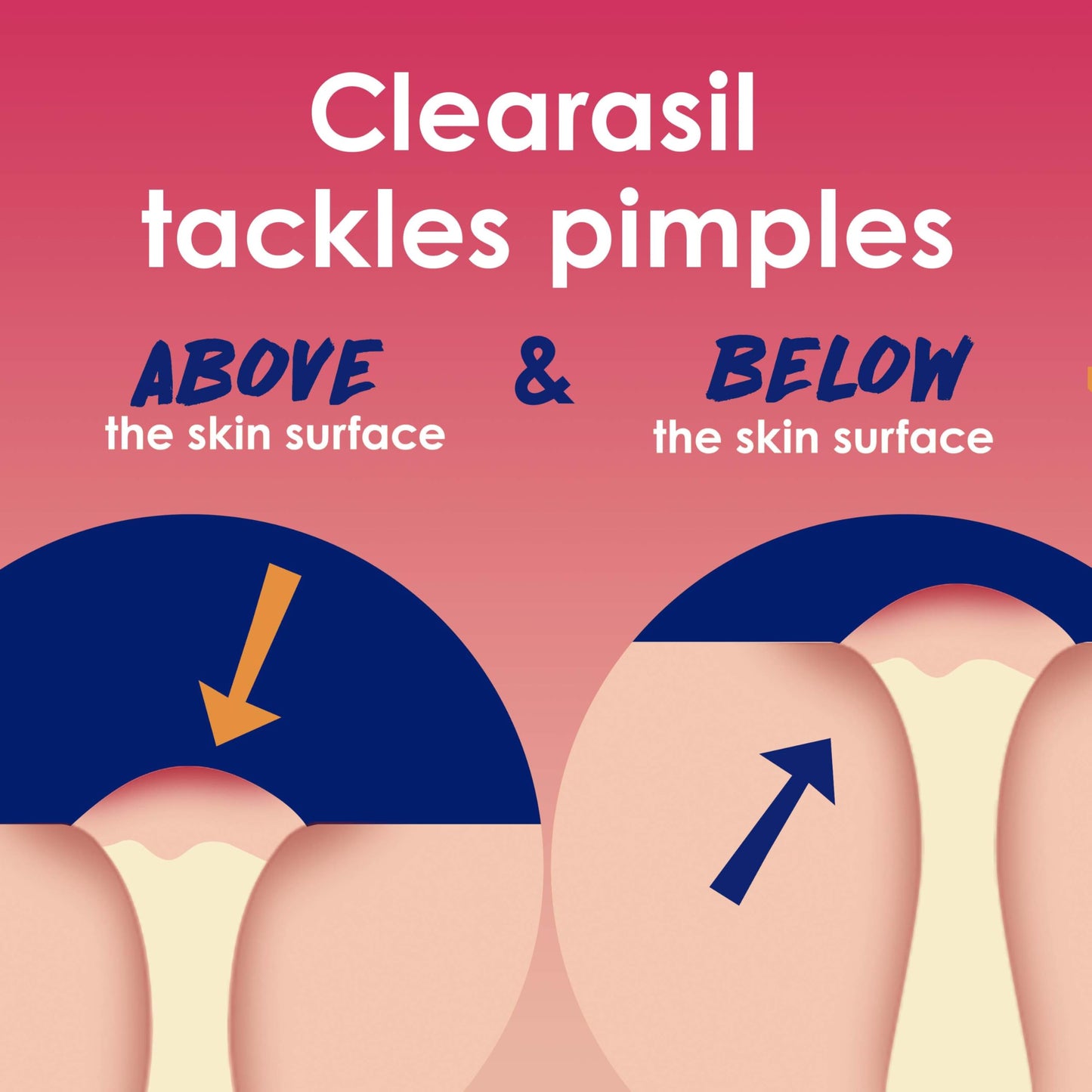 Clearasil Rapid Rescue Deep Treatment Acne Face Pads, Maximum Strenght with 2% Salicylic Acid Acne Treatment Medicine, 90 Count Beauty and Personal Care Clearasil