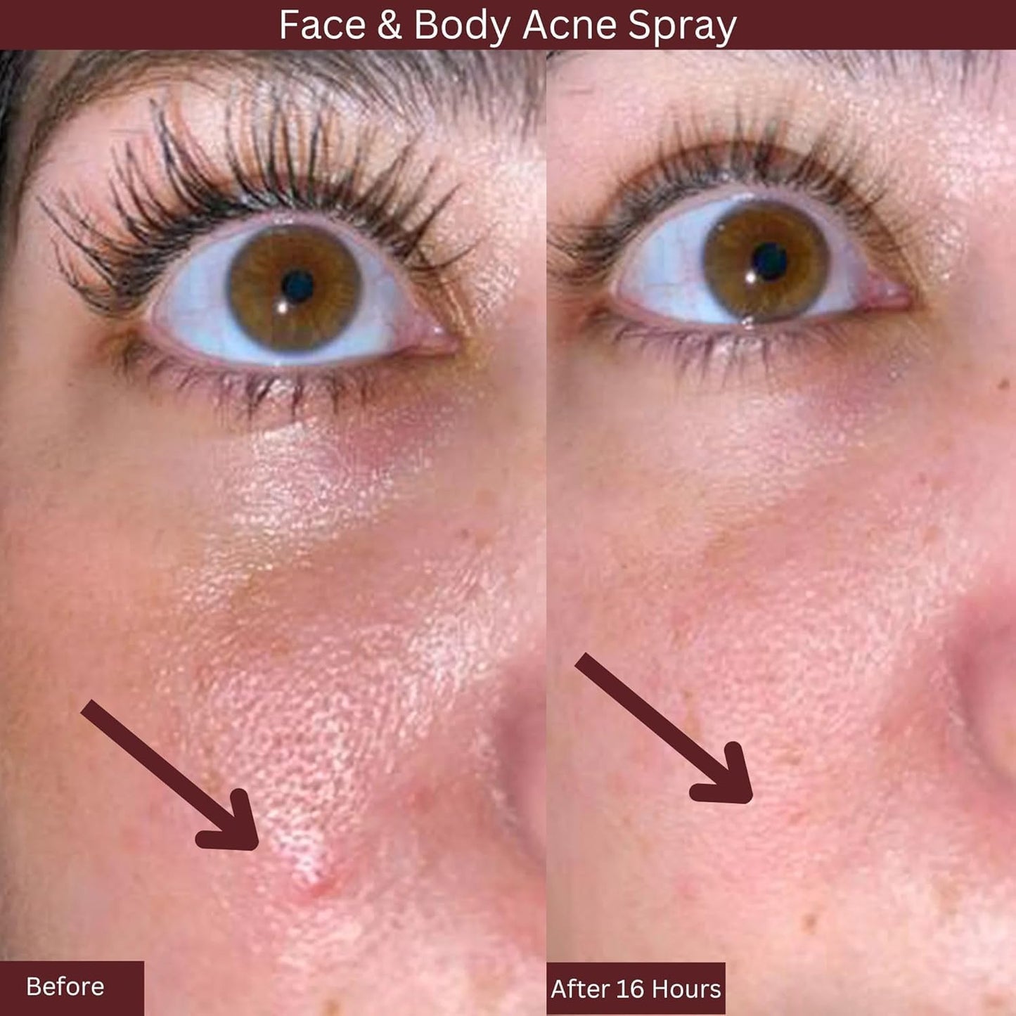 ITK Skincare 2% Salicylic Acid Spray for Face & Body Acne - Blemish-Fighting Treatment for Body Acne, Bacne, Blackheads, Pimples & Blemishes - BHA