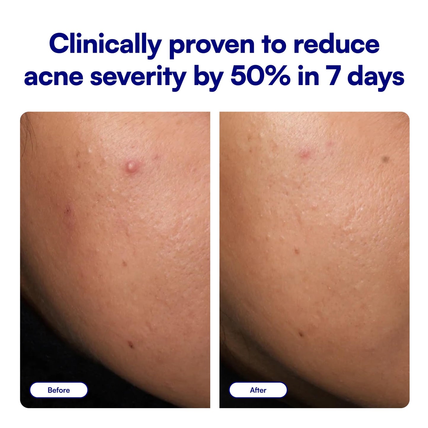 Bliss Clear Genius Acne Spot Treatment - Maximum Strength 2% Salicylic Acid Shrinks Blemishes - Clean, Vegan, Cruelty-Free, 0.5 Fl Oz