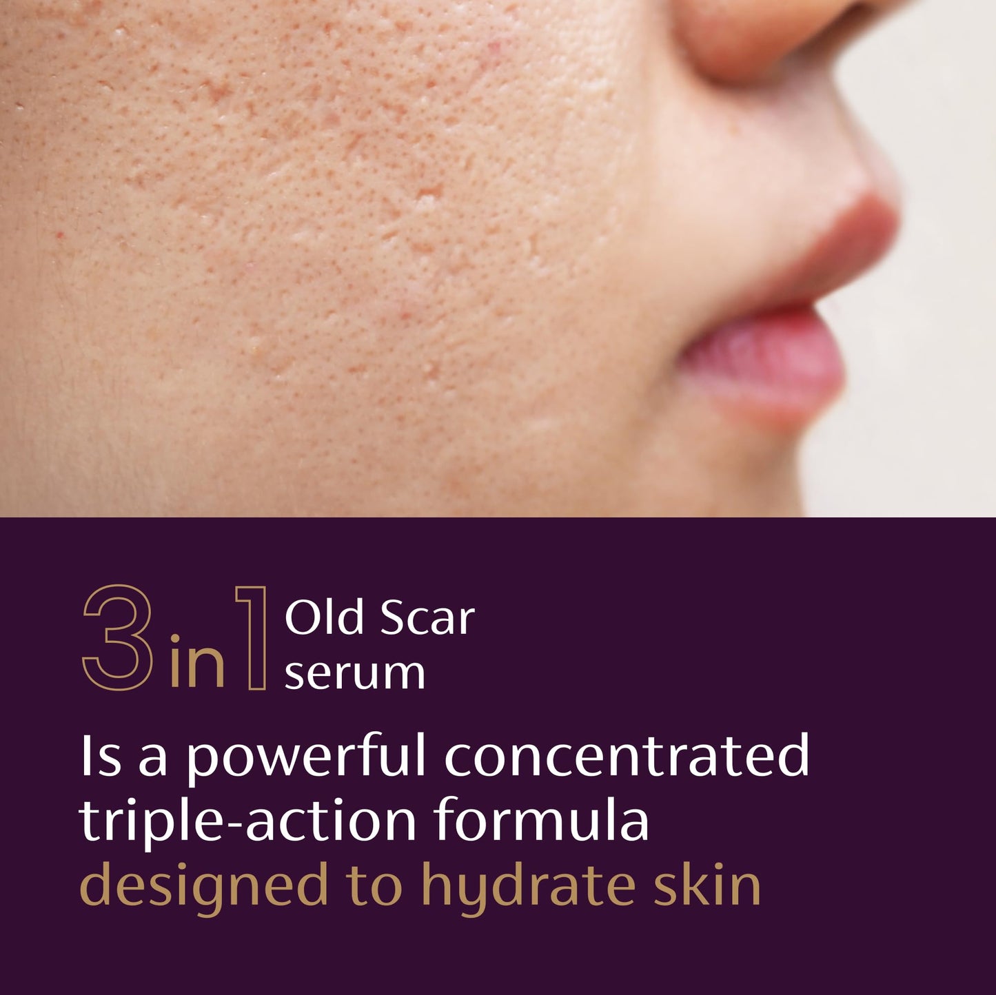 Mederma Scar Serum - Triple-Action Formula with Vitamin E, Hyaluronic Acid & Niacinamide - Clinically Shown to Reduce Old Scars, 1 Fl. Oz. Beauty and Personal Care Mederma