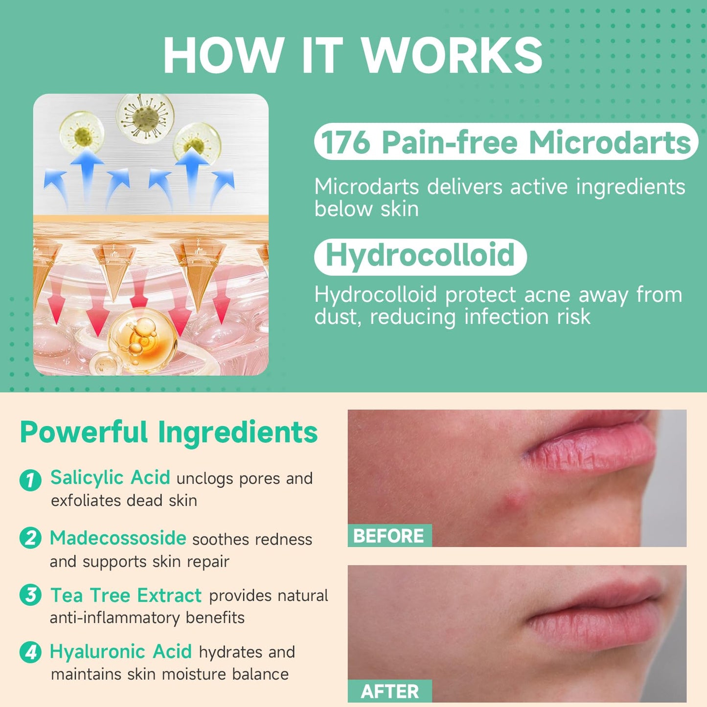 144-Count Microdart Acne Patches, Hydrocolloid Pimple Patches with Salicylic Acid & Madecossoside, Microdart Zit Patches for Deep Blemishes & Early Beauty and Personal Care TEAWOO