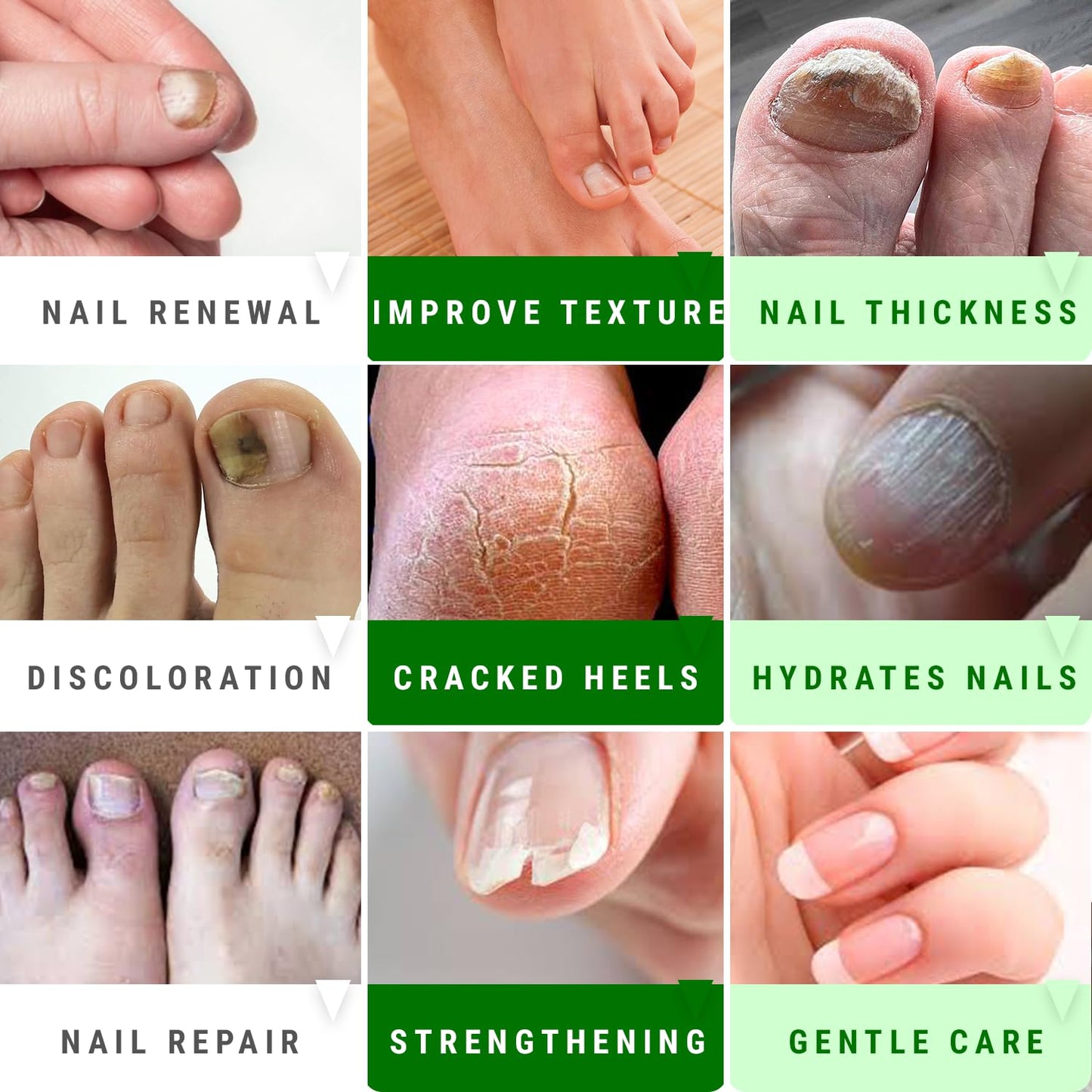 Urea Nail Gel - Softens Cracked Heel Calluses & Thick Toenails - Repairs Damaged, Yellow, Discolored Nails - Highly Effective & Quick-Dry Fingernails
