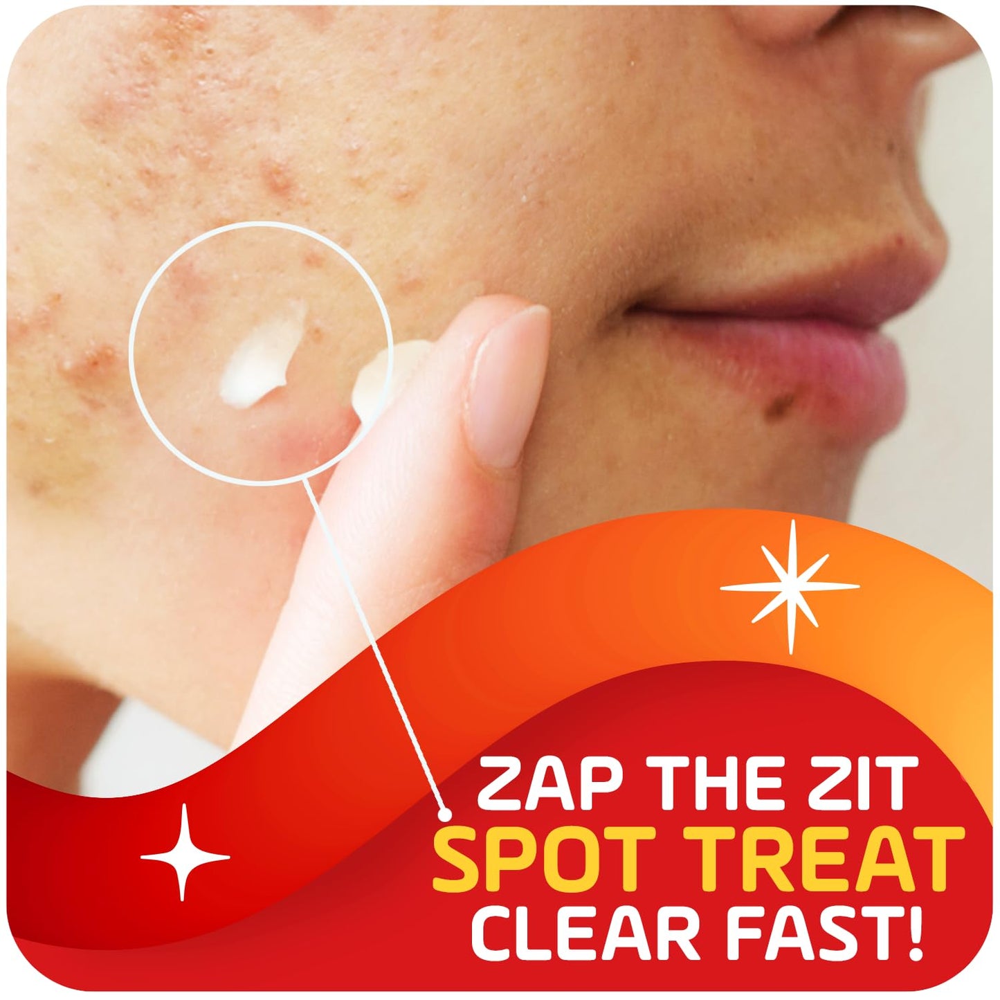 Asepxia 2% Salicylic Acid Acne Spot Treatment Cream | Drying Formula Targets Acne, Clears & Prevents Blemishes, Reduces Redness, Penetrates Pores