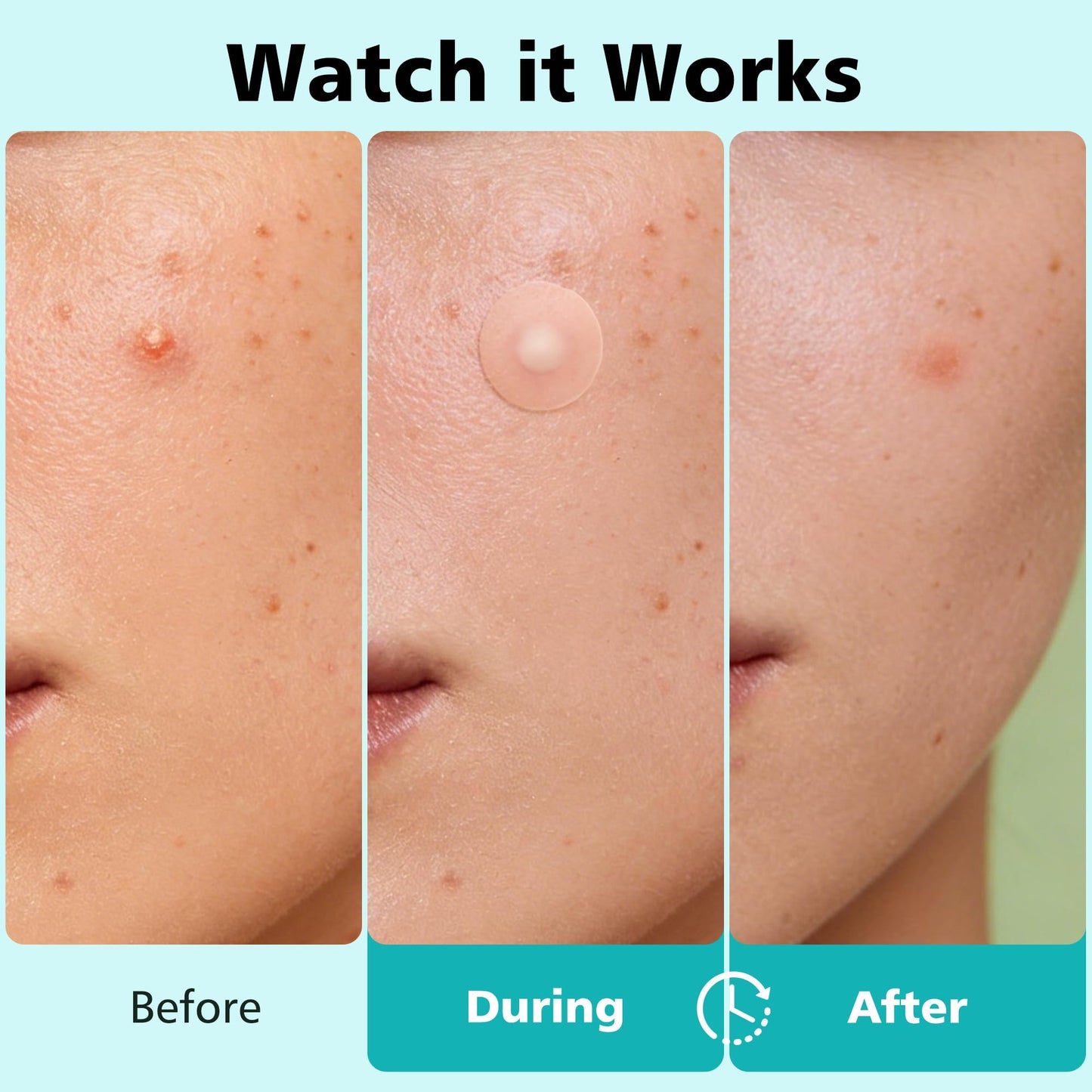 Dr.patch Pimple Patches for Face - 4 Size 600 Counts Acne Patches, Hydrocolloid Patches for Covering Zits and Blemishes, Spot Stickers with Salicylic