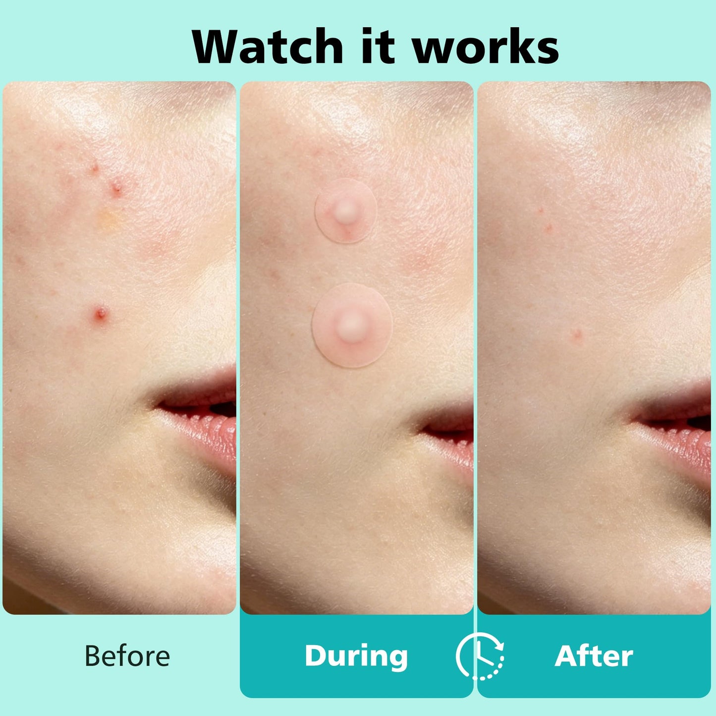 Dr.patch 563 Count Pimple Patches - Hydrocolloid Acne Patches for Face & Body, Invisible Thin, Large & Small Sizes for Whiteheads, Zits & Breakouts Beauty and Personal Care Dr.patch
