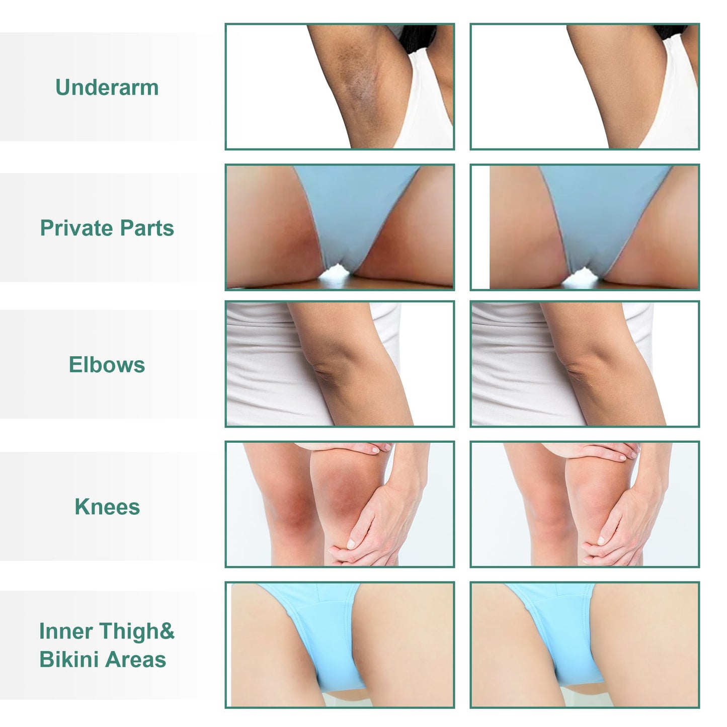 Vcetree Skin Bleaching Cream Skin Lightening for Body Intimate Areas, Private Parts, Underarm, Knees, Elbows, Inner Thigh, Bikini Area, Whitening Beauty and Personal Care Vcetree