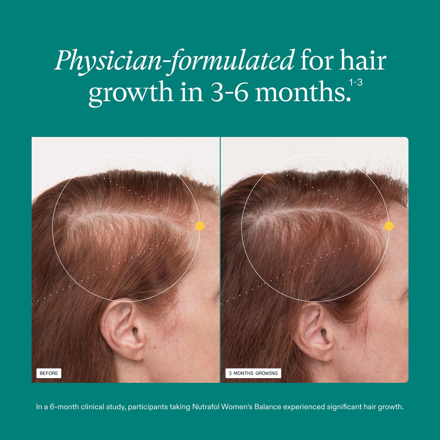 Nutrafol Women's Balance Hair Growth Supplements, Ages 45 and Up, Clinically Proven for Visibly Thicker Hair and Scalp Coverage in 3-6 Months Beauty and Personal Care Nutrafol