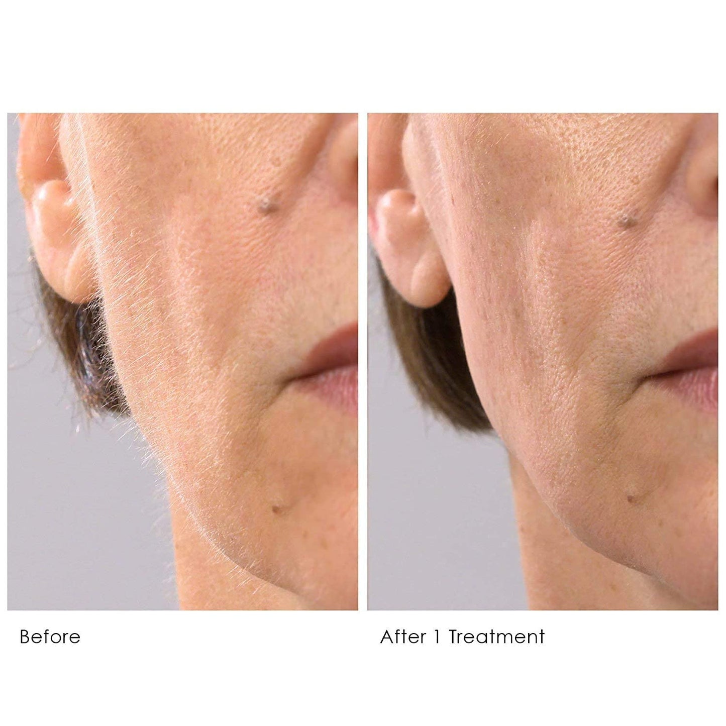 Michael Todd Beauty - Sonicsmooth Pro+ Dermaplaning Blade Refills - 8 Dermaplaning Blades- 2 Month Supply - Device Not Included