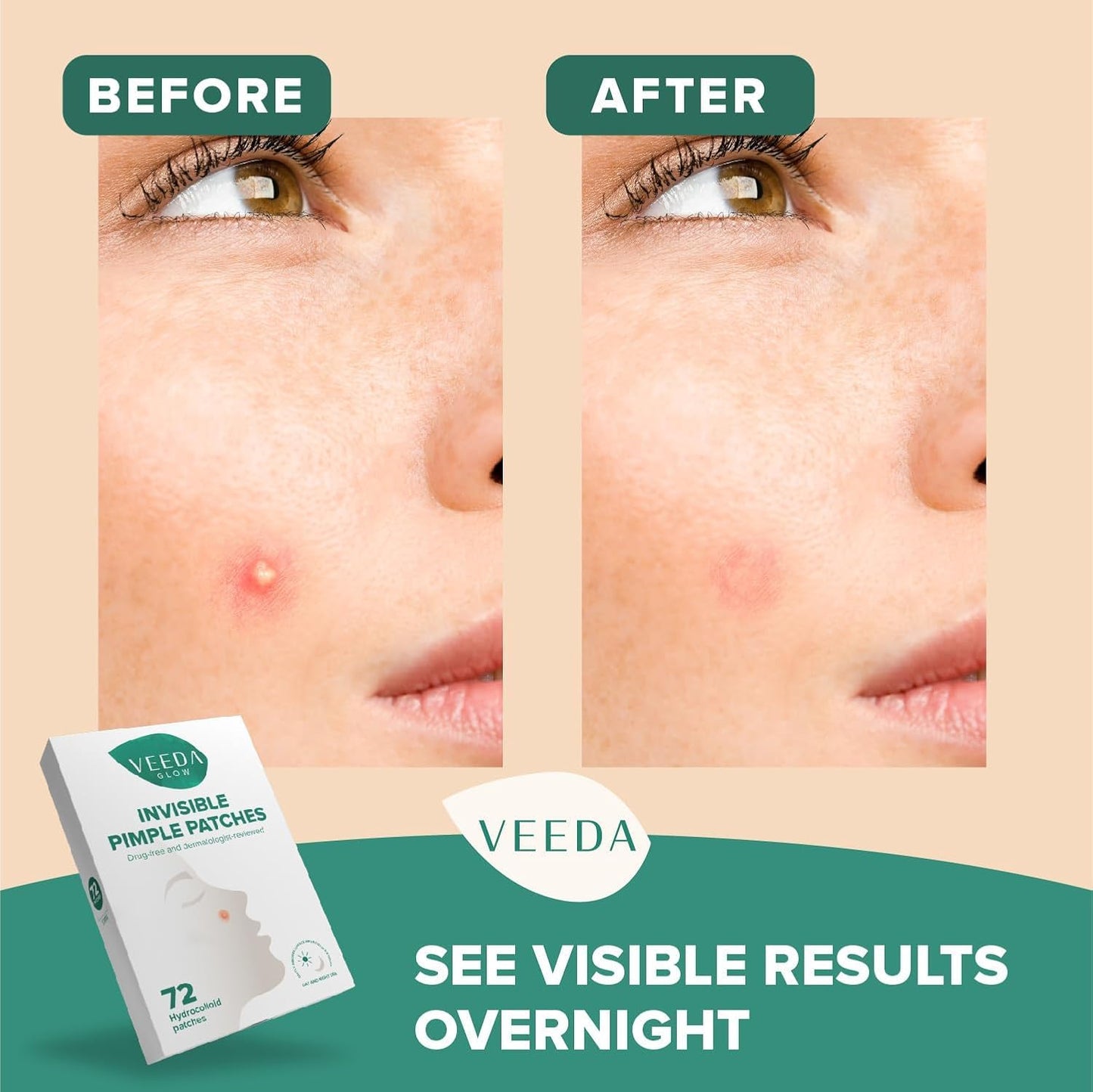 Veeda Glow Pimple Patches - Hydrocolloid Acne Stickers for Fast Healing, Invisible & Non-Irritating Zit Covers, Blemish Spot Treatment, 72 Count