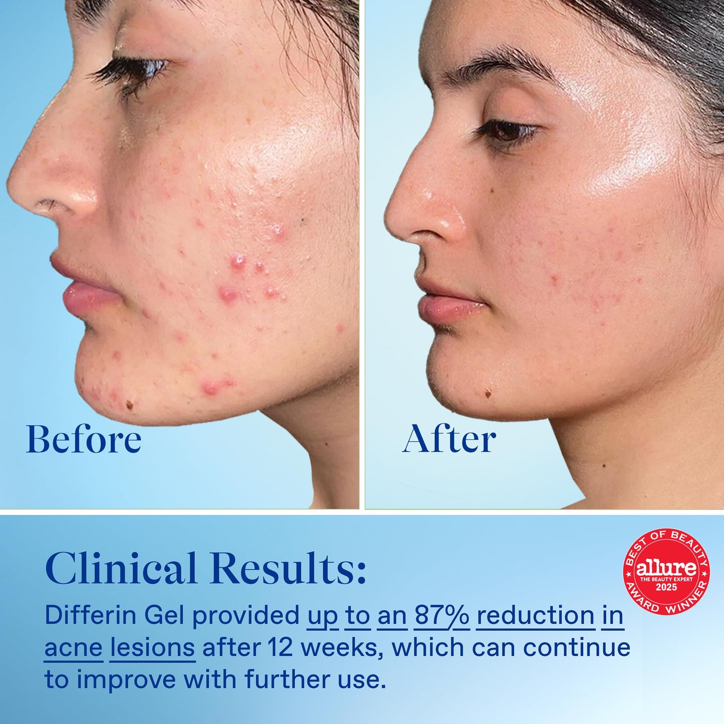 Differin Acne Treatment Gel, 30 Day Supply, Retinoid Treatment for Face with 0.1% Adapalene, Gentle Skin Care for Acne Prone Sensitive Skin, 15g Pump