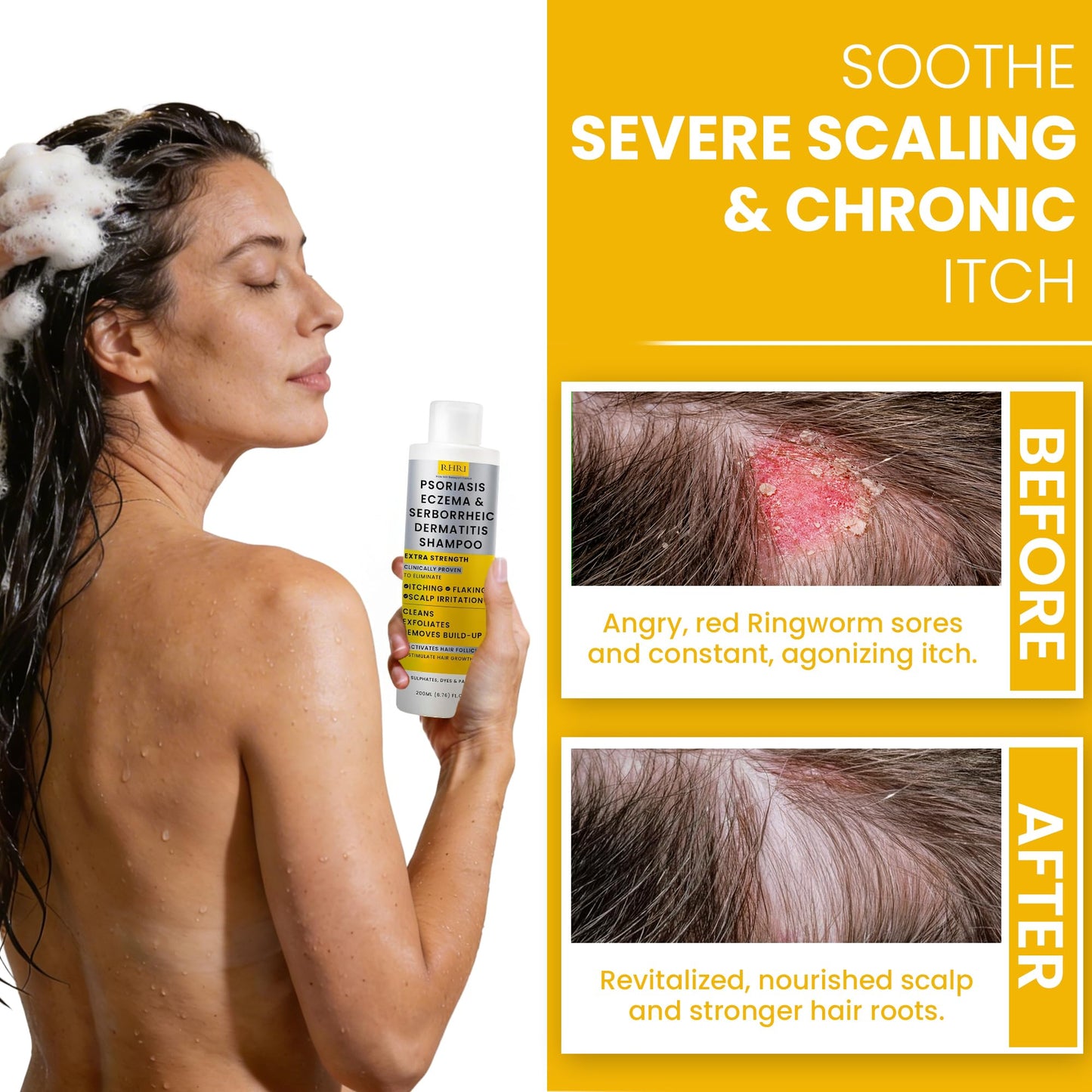 RHRI Psoriasis Shampoo for Men & Women | Itchy Scalp Treatment with Manuka Honey | Best for Eczema, Seborrheic Dermatitis, Ringworm & Folliculitis Beauty and Personal Care Rida Hair Research Institute