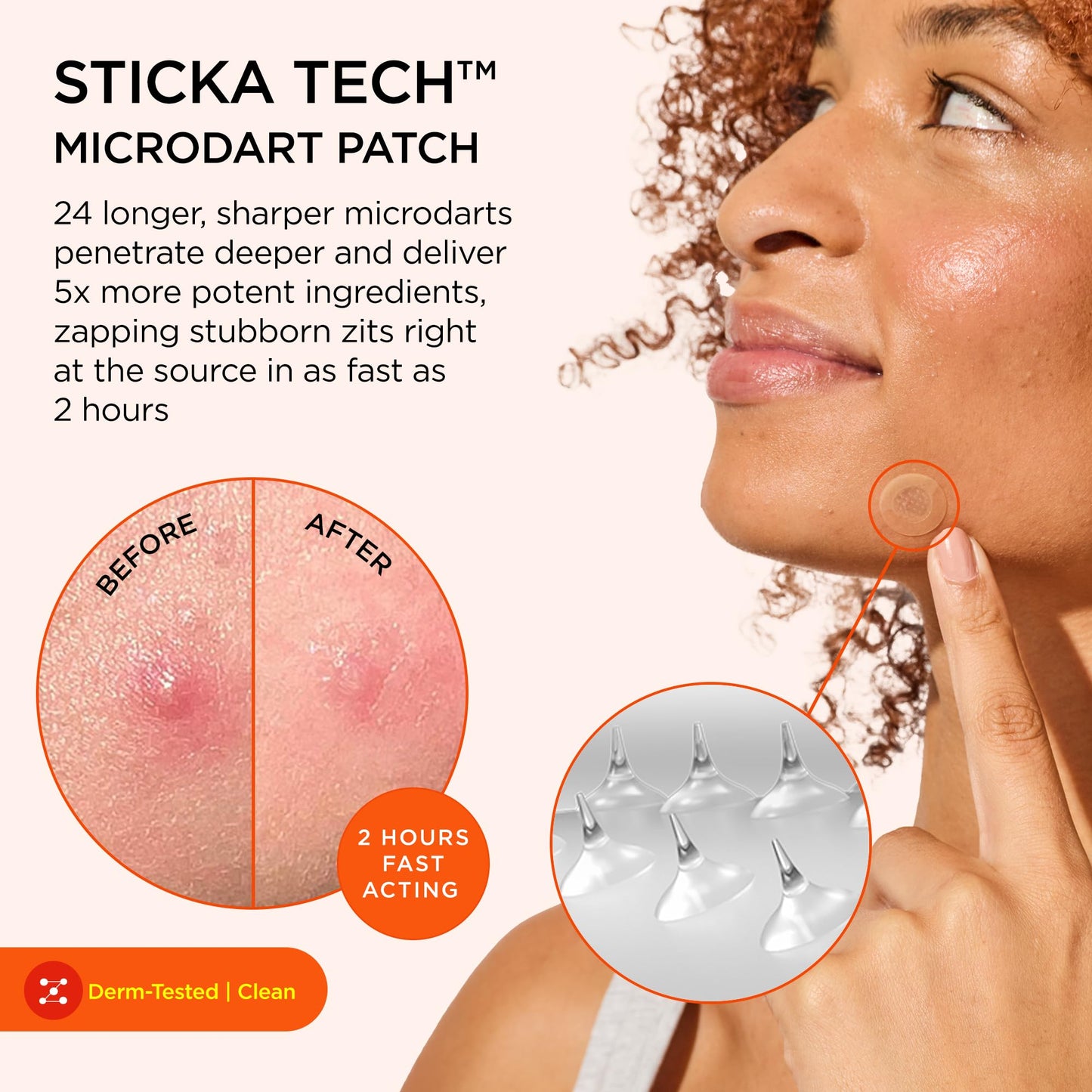 ZitSticka Extra Strength Killa Acne Microdart Patches for Face - OTC Acne Treatment with 2% Salicylic Acid - Fast Acting Microdarts for Deep Beauty and Personal Care ZitSticka
