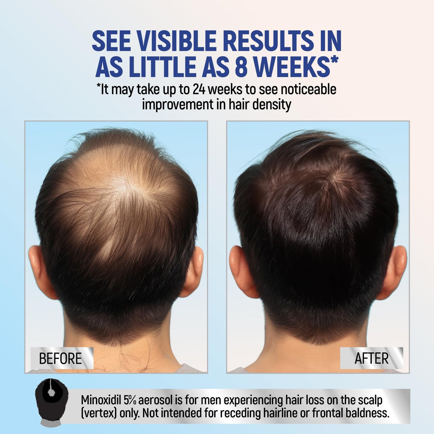 Minoxidil 5% Topical Aerosol Foam, Hair Regrowth 4 Months Treatment for Men, 2.11 oz (4 Pack) Beauty and Personal Care TARO