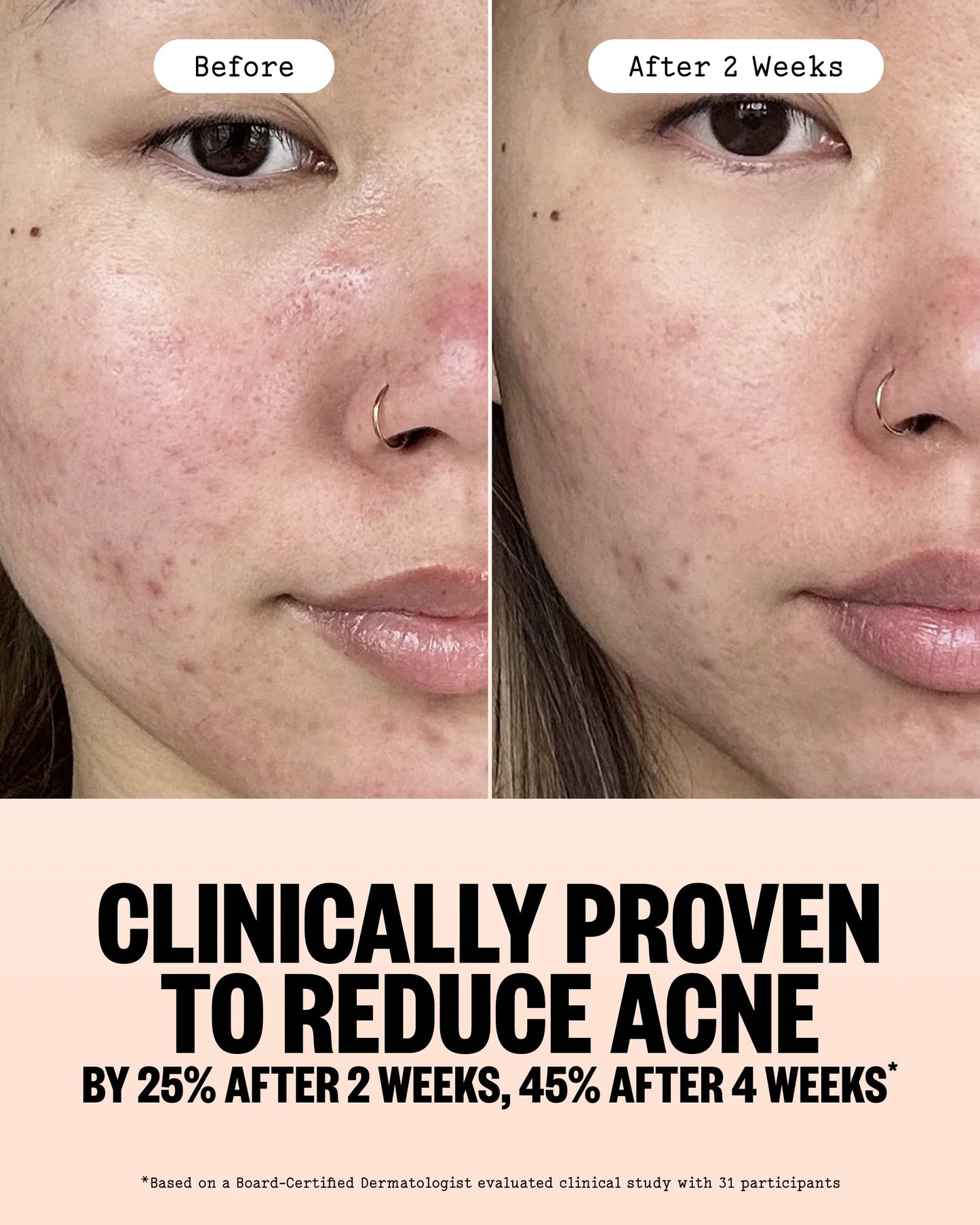 PEACE OUT Acne Gel Cleanser, With 2% Salicylic Acid for Breakouts, Blemishes & Blackheads, Daily Face Wash with Ceramides to Unclog Pores, Support