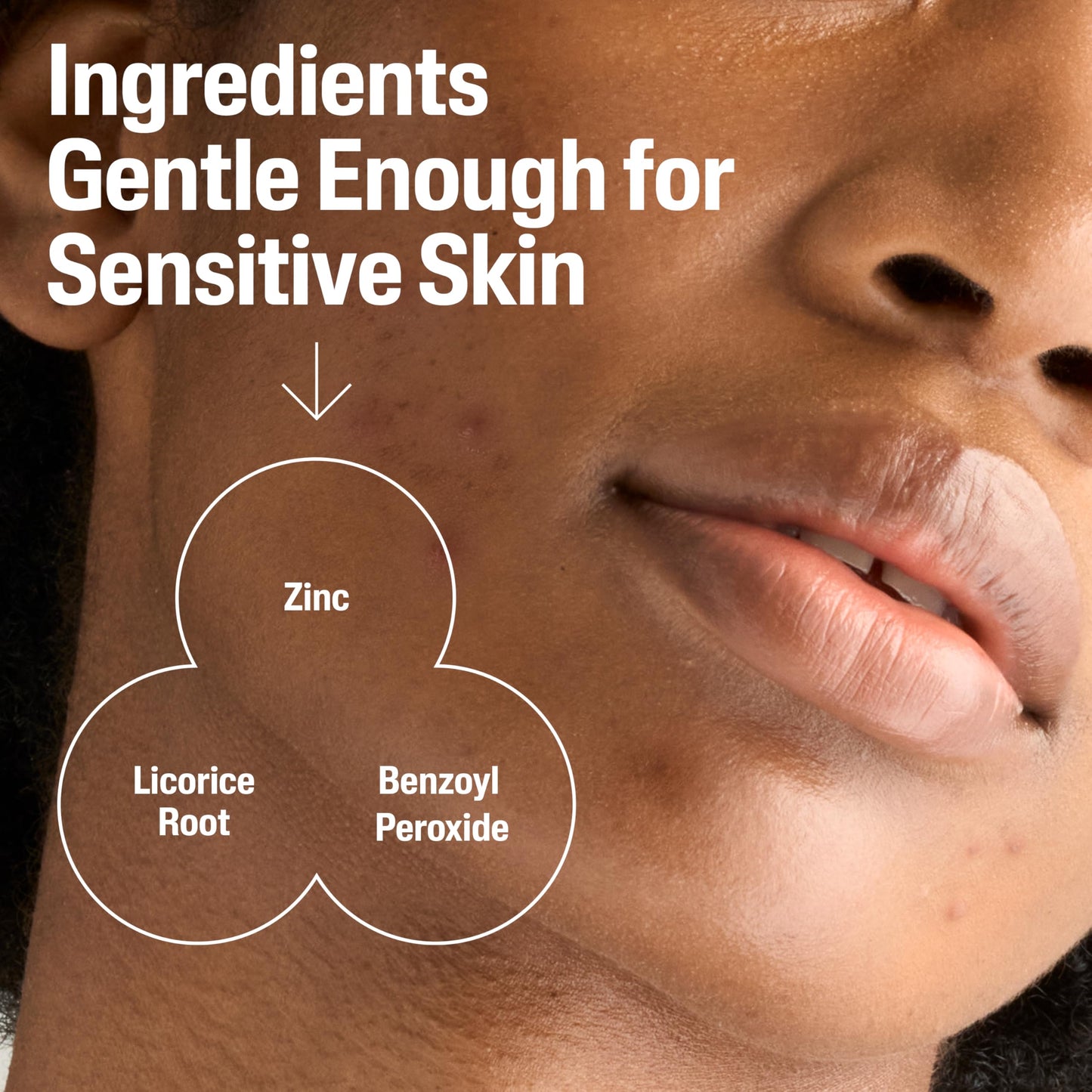 Cetaphil Gentle Clear Complexion-Clearing BPO Acne Cleanser with 2.6% Benzoyl Peroxide, Creamy and Soothing for Sensitive Skin, Suitable for All Skin