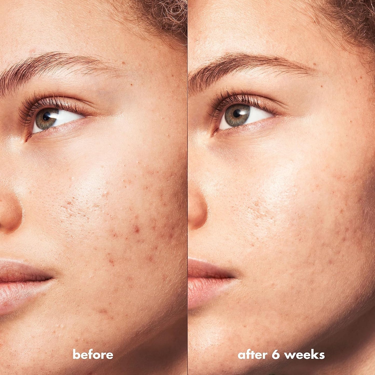 e.l.f. SKIN Blemish Breakthrough Triple-Acid Resurfacing Serum, Hydrating Night Serum For Fighting Blemishes, Helps Improve Skin Tone & Texture