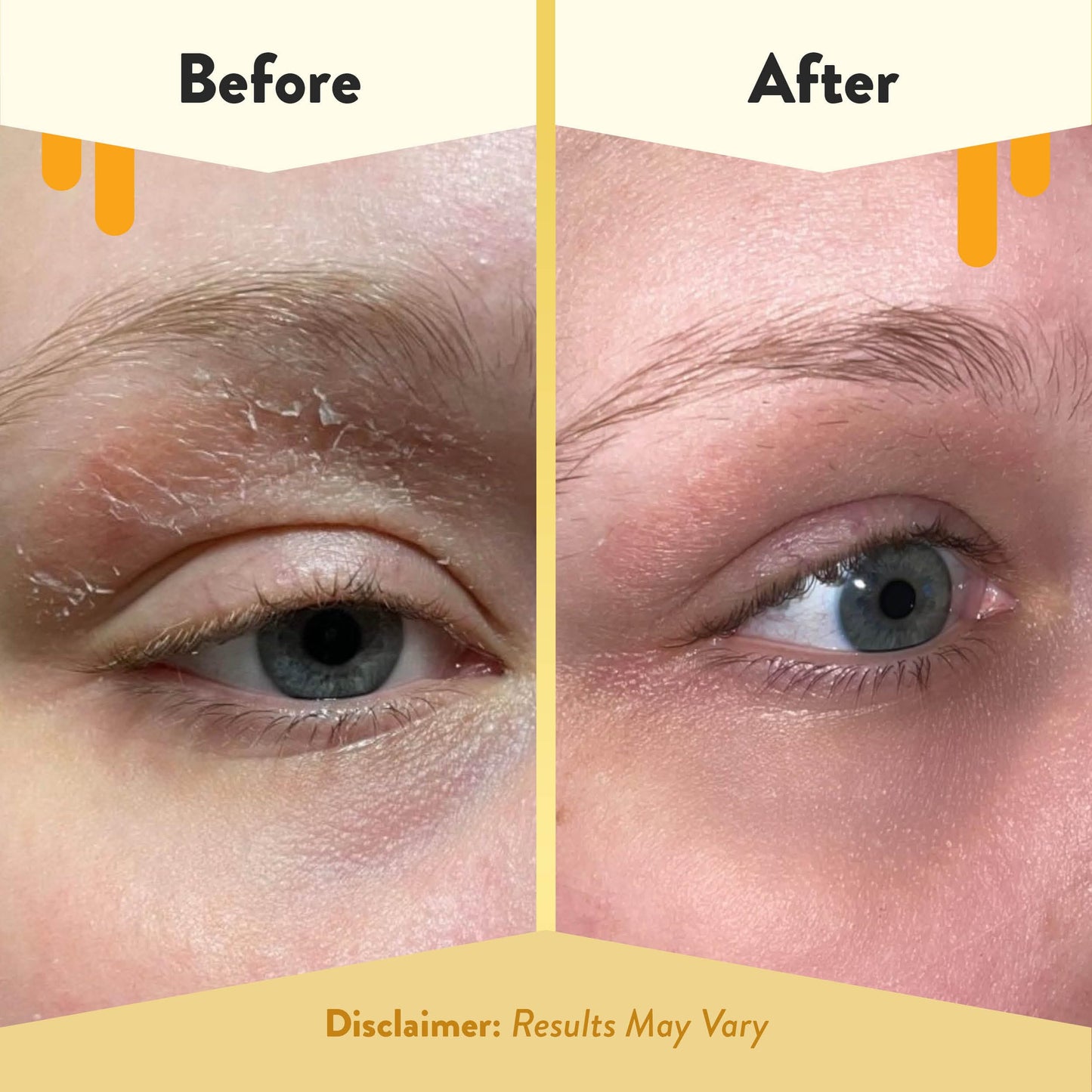 Eczema Honey Multi Peptide Eye Cream 0.5 oz – Anti-Aging Formula for Dark Circles, Puffiness & Fine Lines | Gentle for Eczema & Sensitive Skin