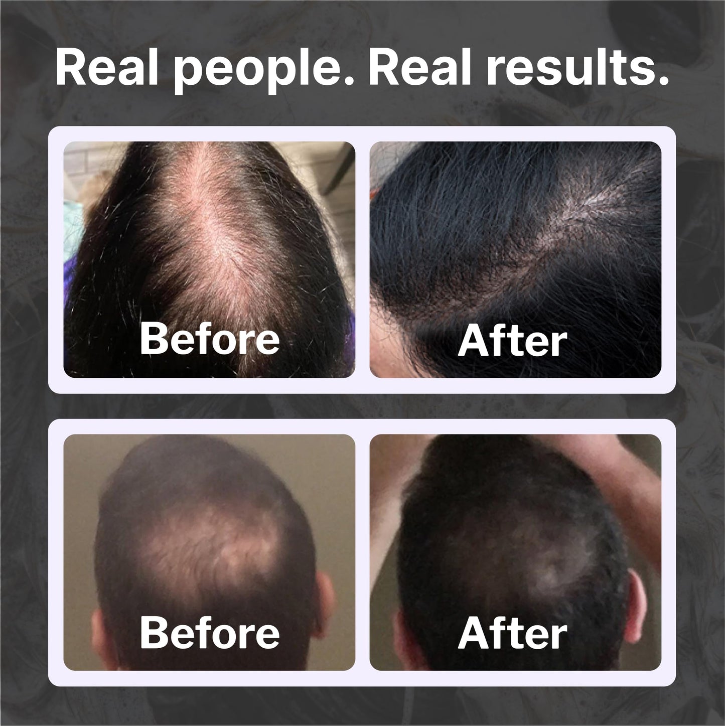Shapiro MD Hair Growth Experts Natural Hair Kit for Thicker, Fuller, Healthier Looking Hair - Including Shampoo, Conditioner and Leave-In Daily Foam