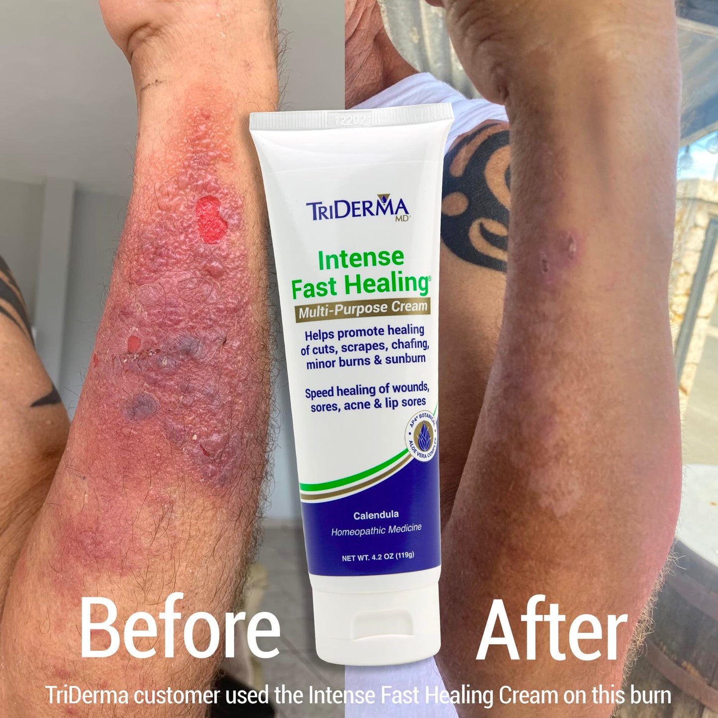 TriDerma Intense Fast Skin Healing Cream for Hard-to-Heal Skin Irritations, Sores, Rashes, Dry, Cracked Hands, Cuts, Chafing, Burns, Scrapes - First