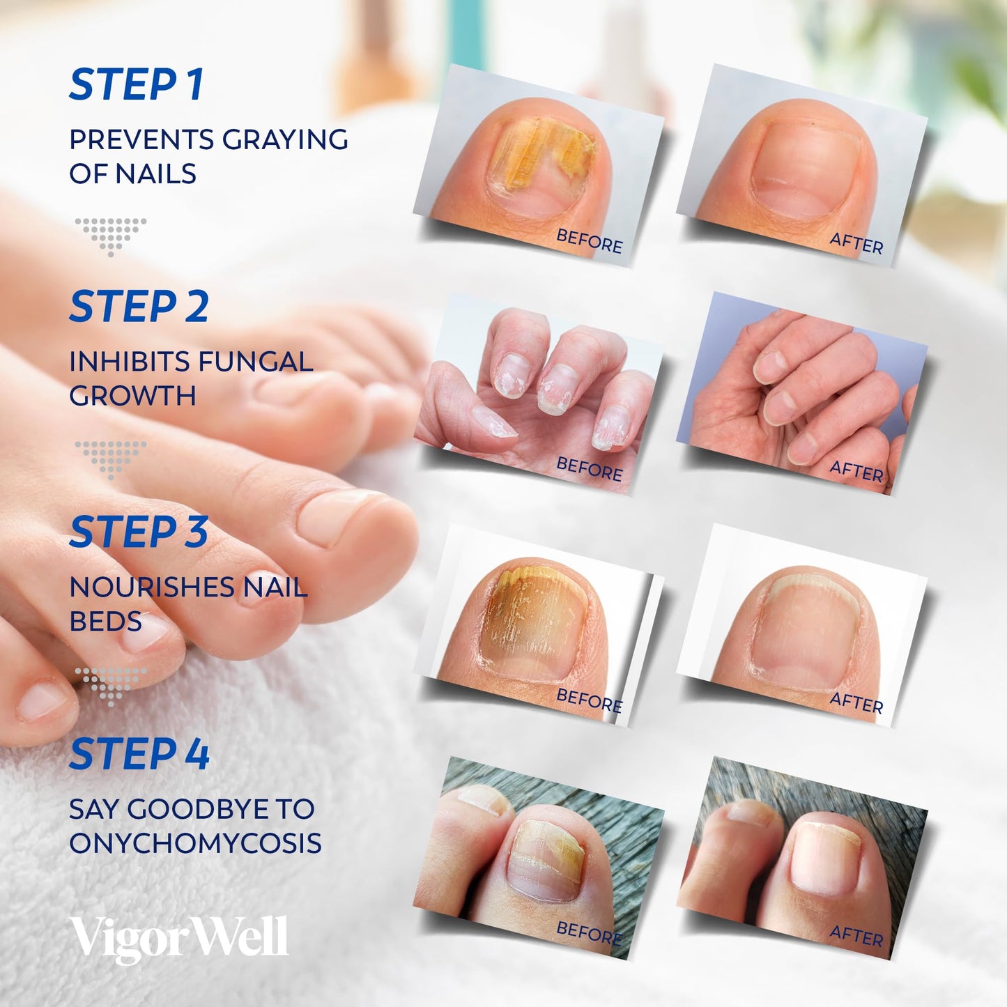 Toenail Fungus Treatment Extra Strength - (Medium) 32 Nighttime Hydrogel Patches for Overnight Toenail Repair - Visible Results in 8 Hours - Fungal Beauty and Personal Care VigorWell