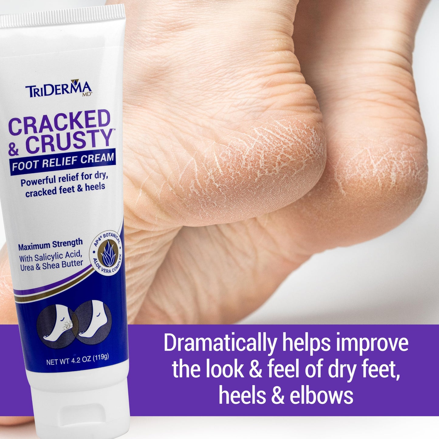 TriDerma Cracked & Crusty™ Healthy Foot Cream Moisturizes, Softens and Heals Dry Feet, Cracked Heels and Dry Elbows with Salicylic Acid, Urea, Shea
