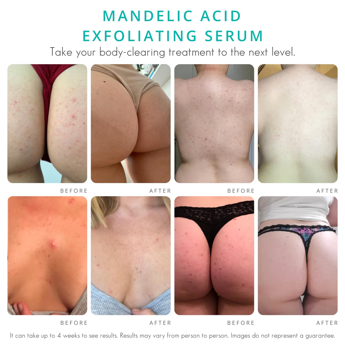 Almond Clear Level 2 Serum | Mandelic Acid Body Serum for Acne, Folliculitis, Aging Skin, Ingrown Hairs, Dark Spots on Face, Chest, Butt, Back