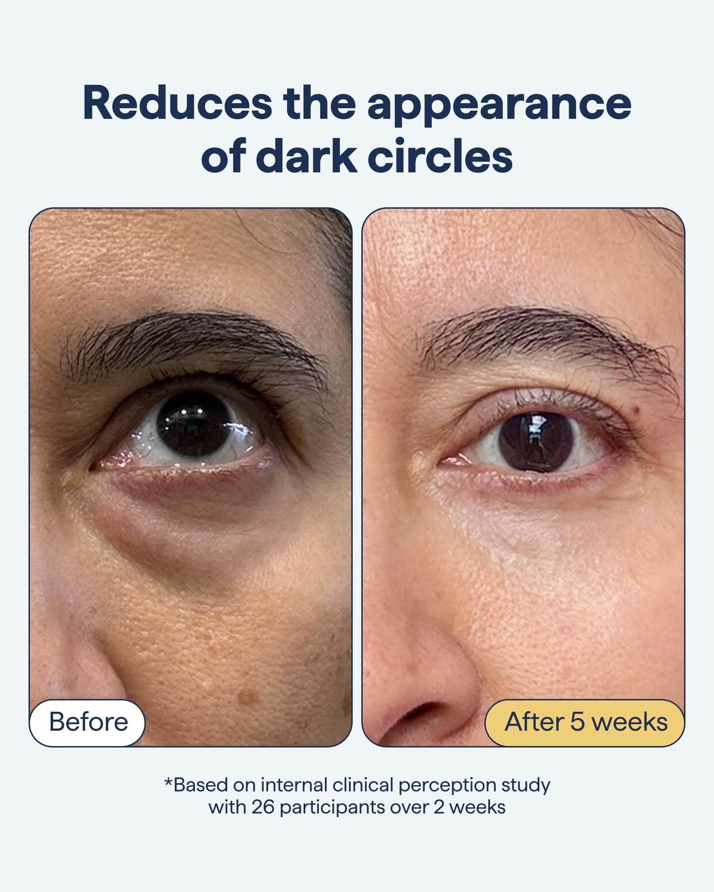 Remedy Dark Circles Reducing Advanced Eye Cream | Undereye Discoloration Treatment | Caffeine, Kojic Acid, Niacinamide, Marine Algae Complex | By Beauty and Personal Care Remedy Science