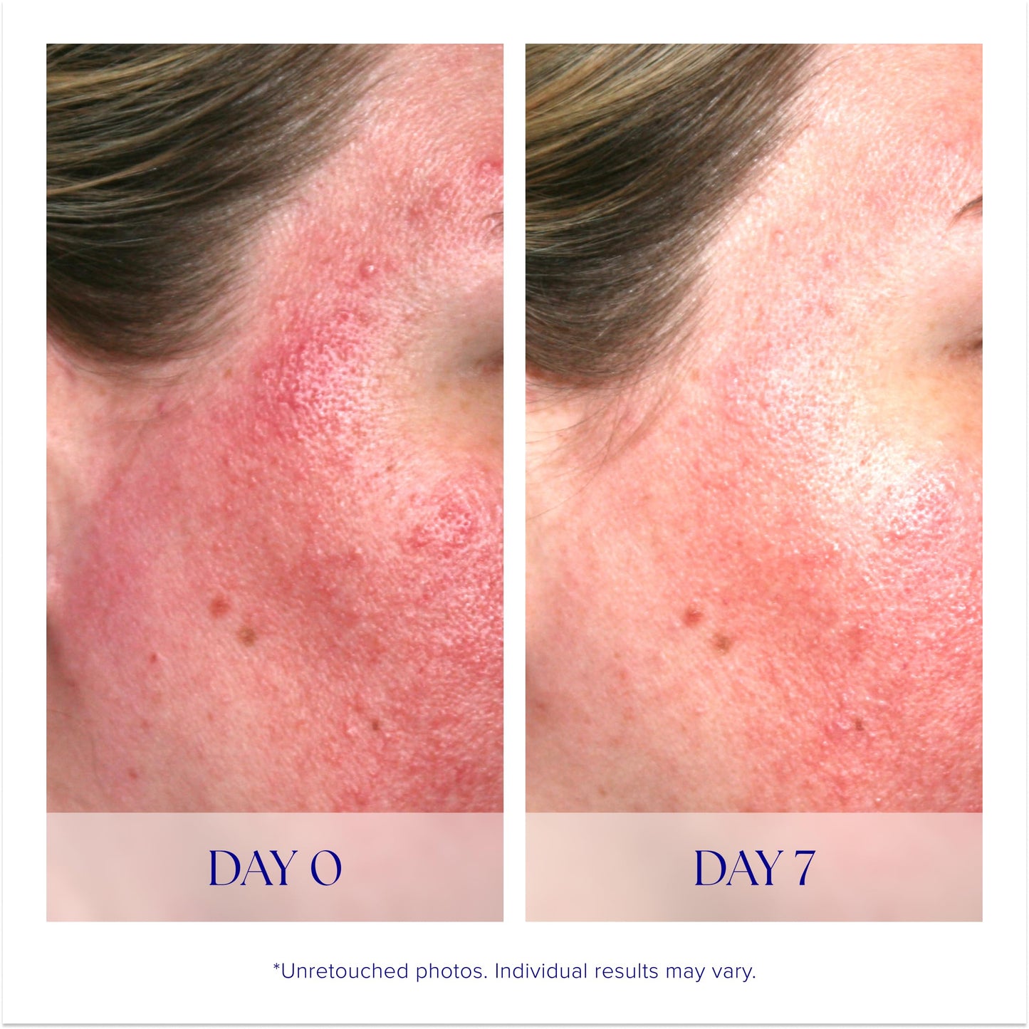 iS CLINICAL Pro-Heal Serum Advance+ Antioxidant-Rich Serum With Vitamin C, E, and A for Redness, Inflammation, Wrinkle-Smoothing, Sun Damage Repairing