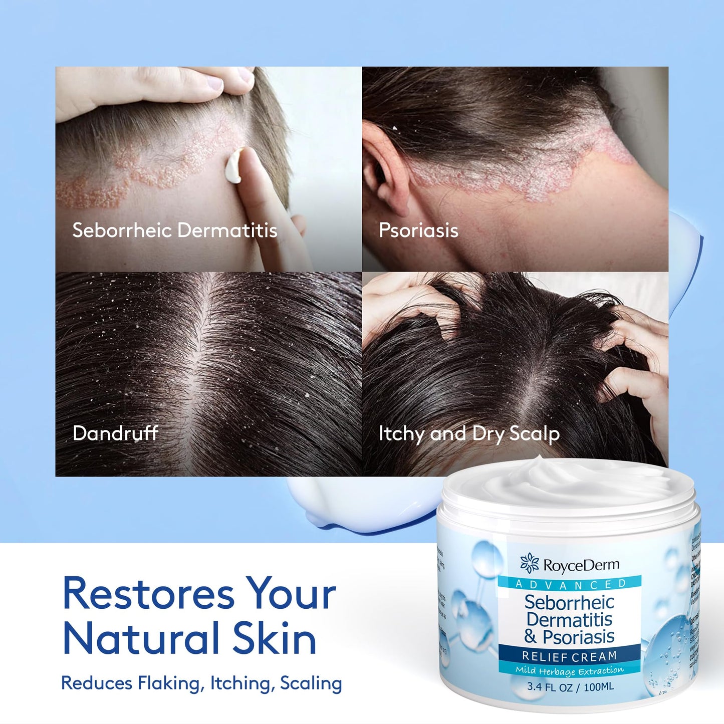 Roycederm Seborrheic Dermatitis & Psoriasis Scalp Treatment Kit - Shampoo + Cream for Dry Itchy Scalp, Dandruff, Scalp Relief Soothing Care System