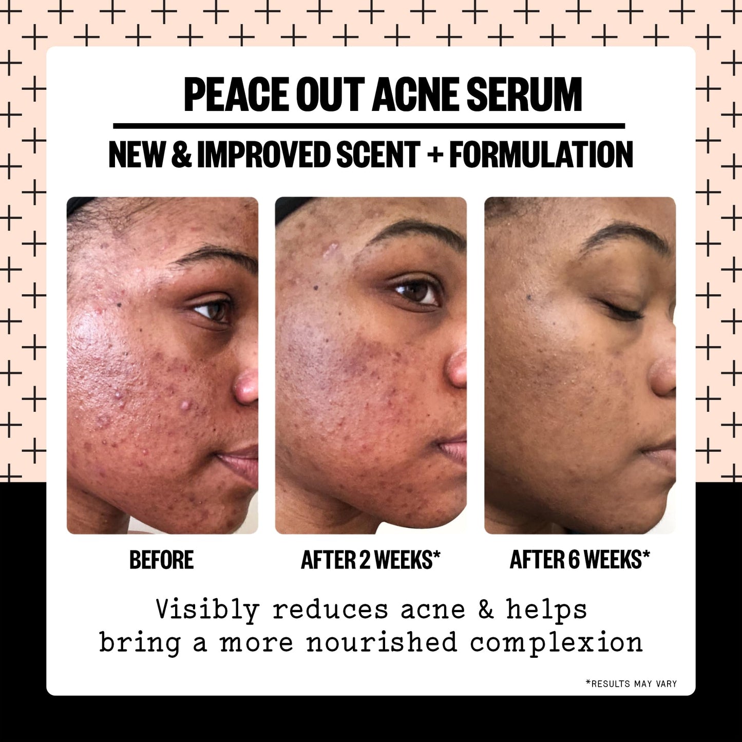 PEACE OUT Skincare Acne Serum. Daily Multi-Benefit Face Serum with 2% Salicylic Acid to Target Pimples, Zits, Blemishes and Breakouts