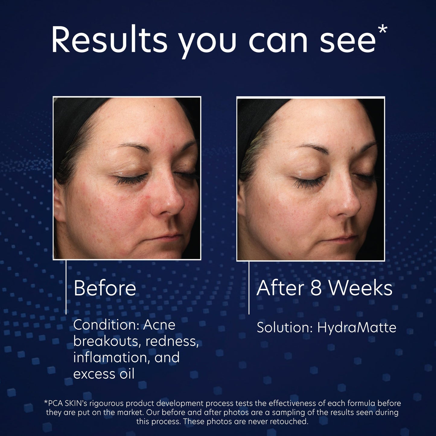 PCA SKIN HydraMatte Oil Control Moisturizer, Face Moisturizer for Oily Skin, Helps Reduce Oil and Promotes a Smoother Complexion, Absorbs Quickly