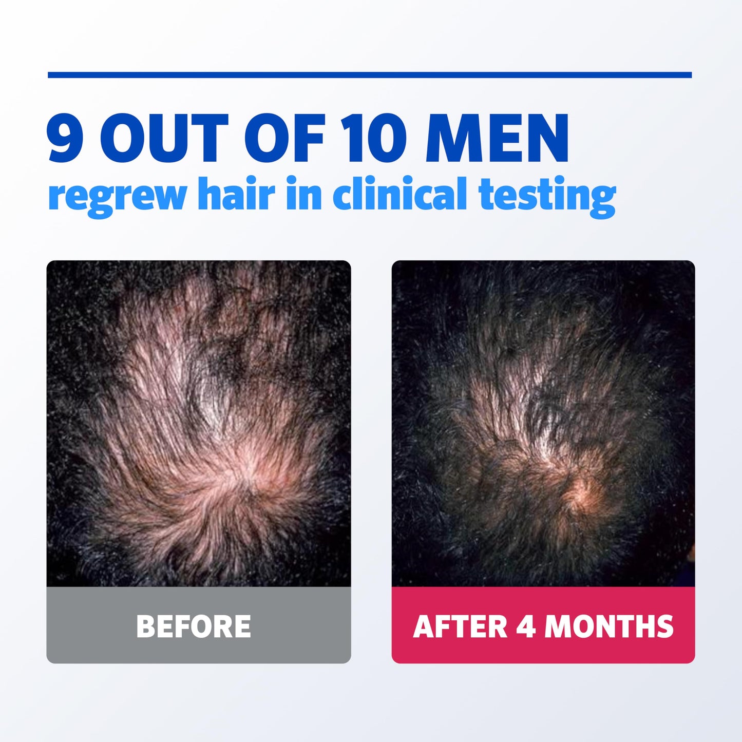 Men's Rogaine 5% Minoxidil Topical Foam, Unscented, 3 Mo Supply, 2.11 Oz (Pack of 18) Beauty and Personal Care Rogaine