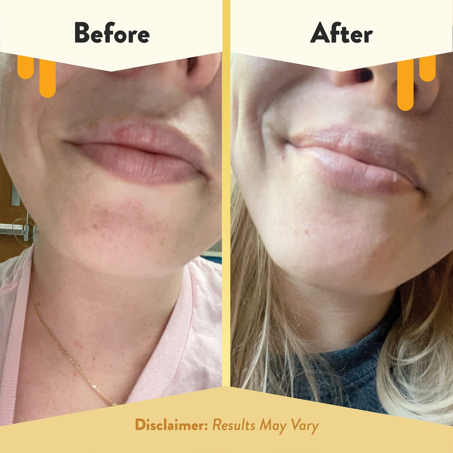 ECZEMA HONEY Nourishing Lip Balm - Organic Chapstick for Sensitive Skin - Daily Lip Moisturizer for Very Dry Lips - Mango Butter & Honey Lip Balm