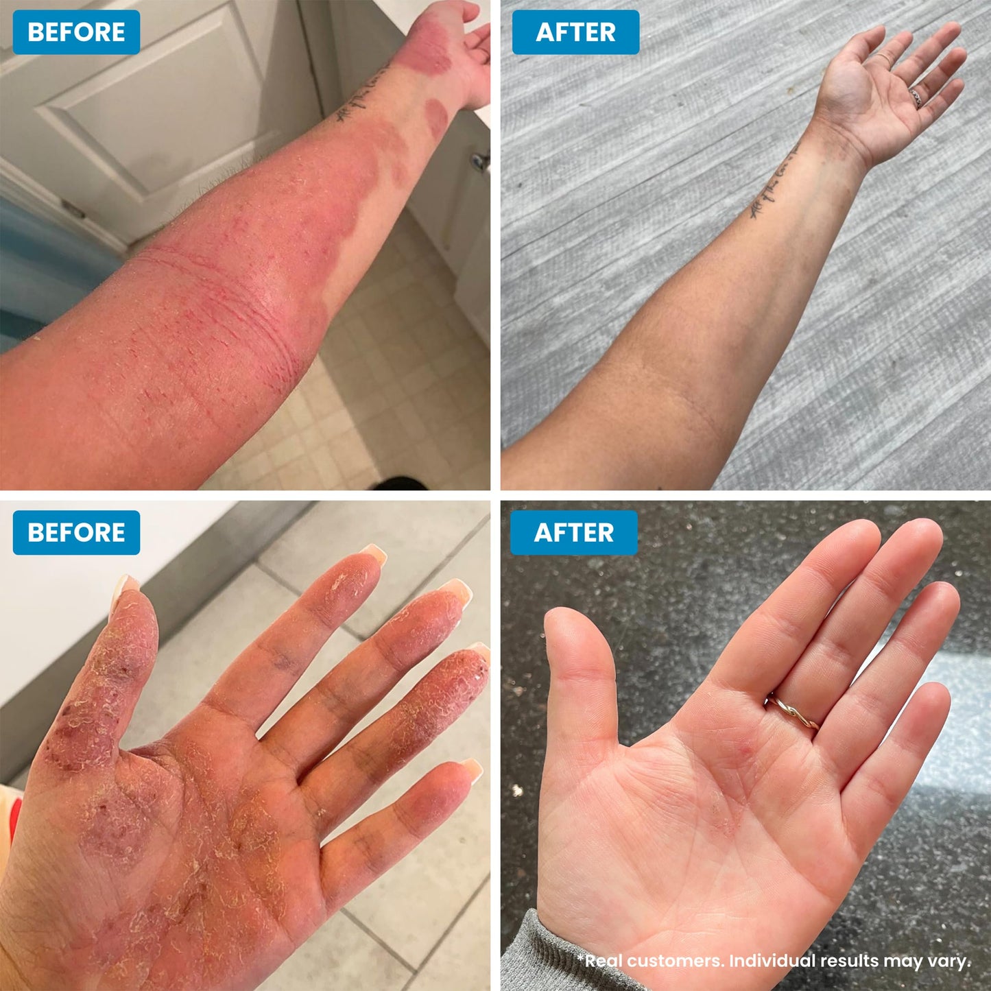 Grahams Natural C+ Eczema & Dermatitis Cream - All-Natural, Steroid-Free - Manuka Honey & Calendula - Clinically Proven Eczema Lotion for Kids