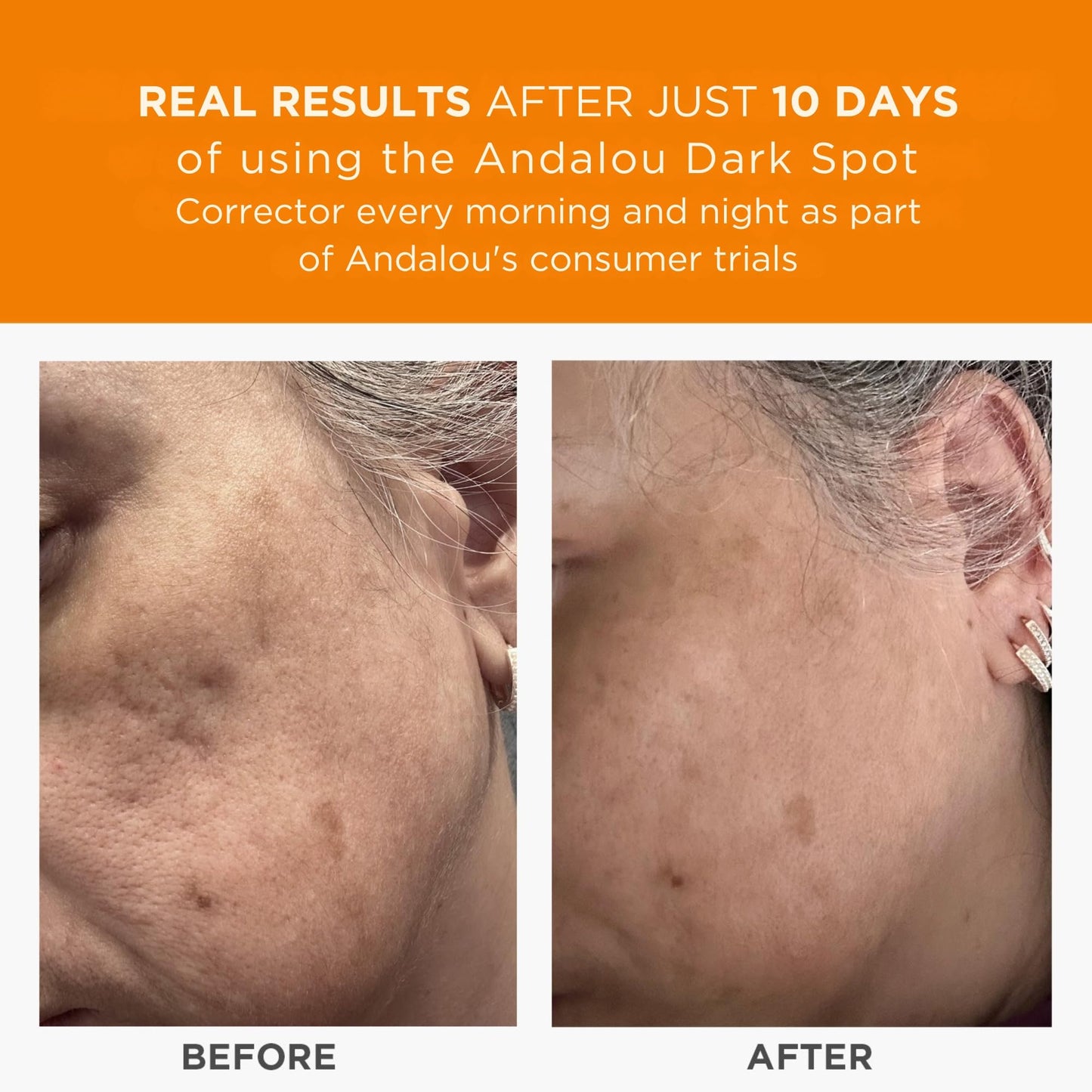 Andalou Naturals Dark Spot Corrector, Complexion Enhancing Face Serum with Vitamin C, May Help Hyperpigmentation, Reduce the Appearance of Acne