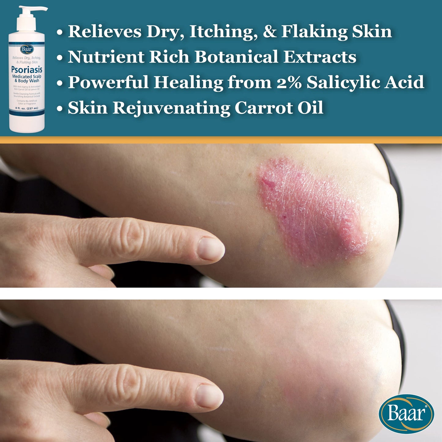 BAAR Psoriasis Therapeutic Scalp & Body Wash, Soothing Healing Formula with 2% Salicylic Acid and Antioxidant-Packed Botanicals like Carrot and Lemon Beauty & Personal Care Baar